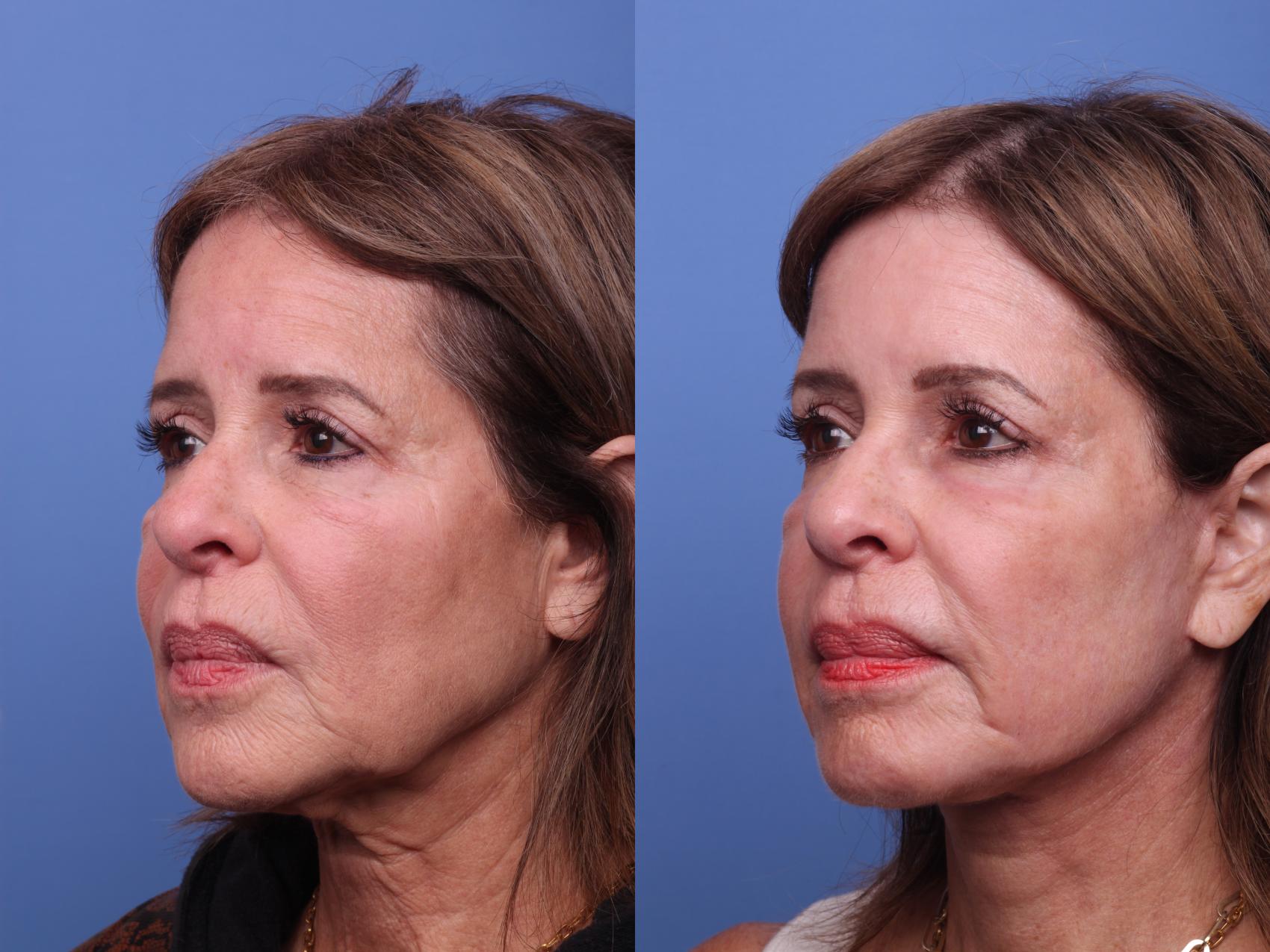 Before & After Facelift Case 367 Left Oblique View in Scottsdale, AZ