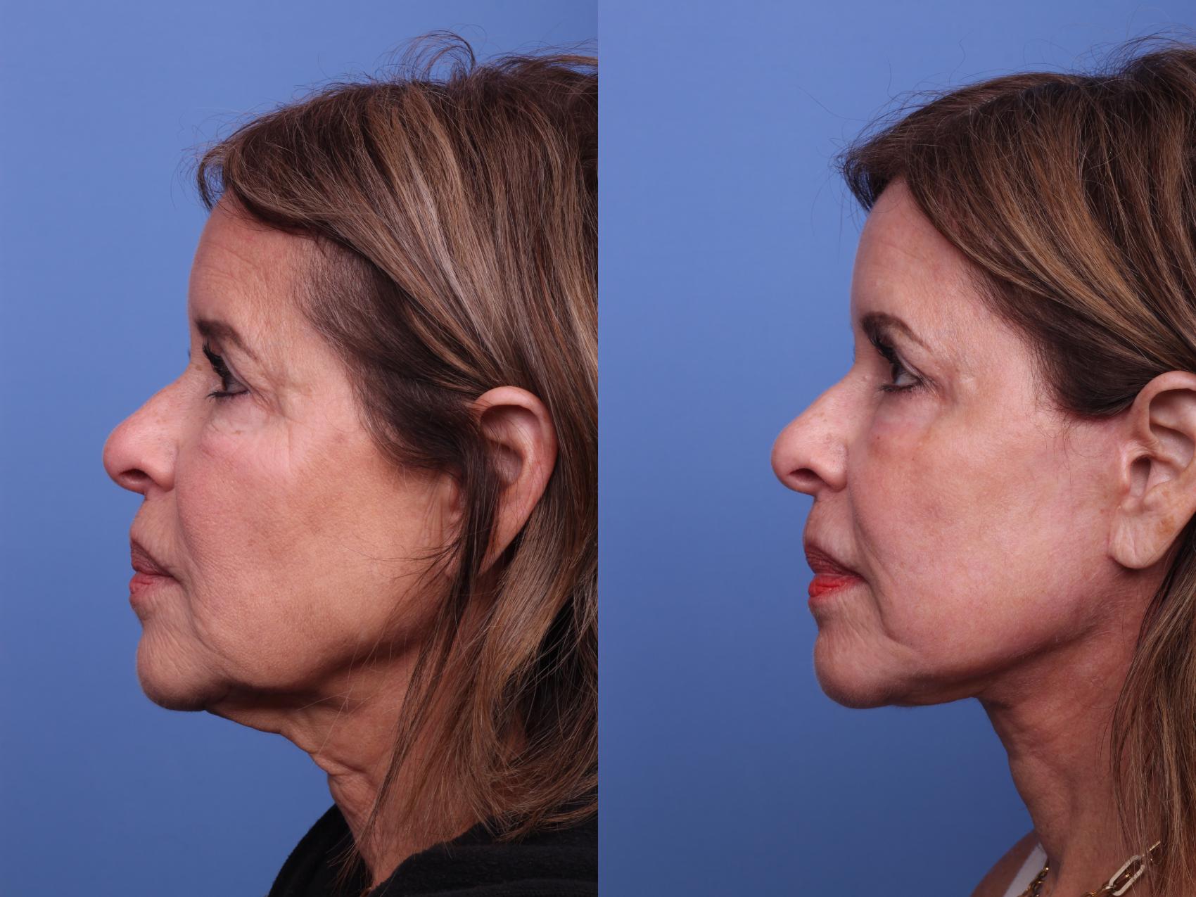 Before & After Facelift Case 367 Left Side View in Scottsdale, AZ