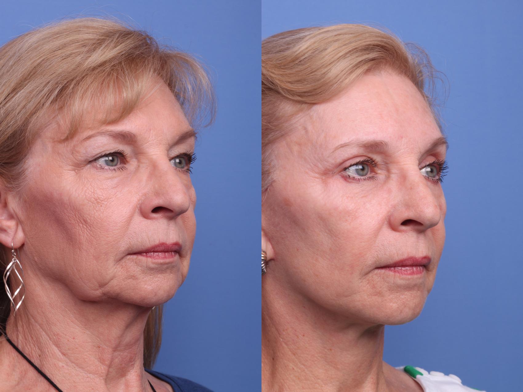Before & After Facelift Case 374 Right Oblique View in Scottsdale, AZ