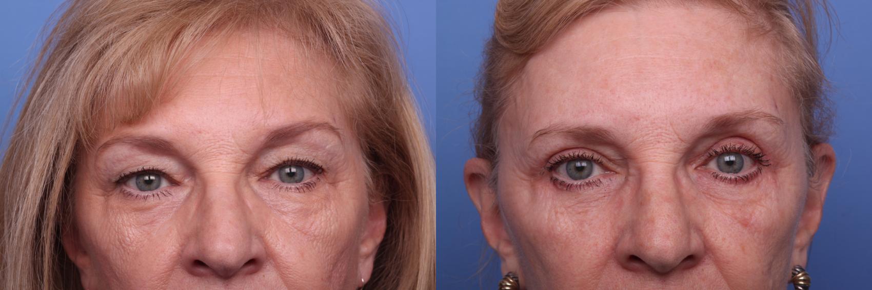 Before & After Facelift Case 374 Zoom Bleph View in Scottsdale, AZ