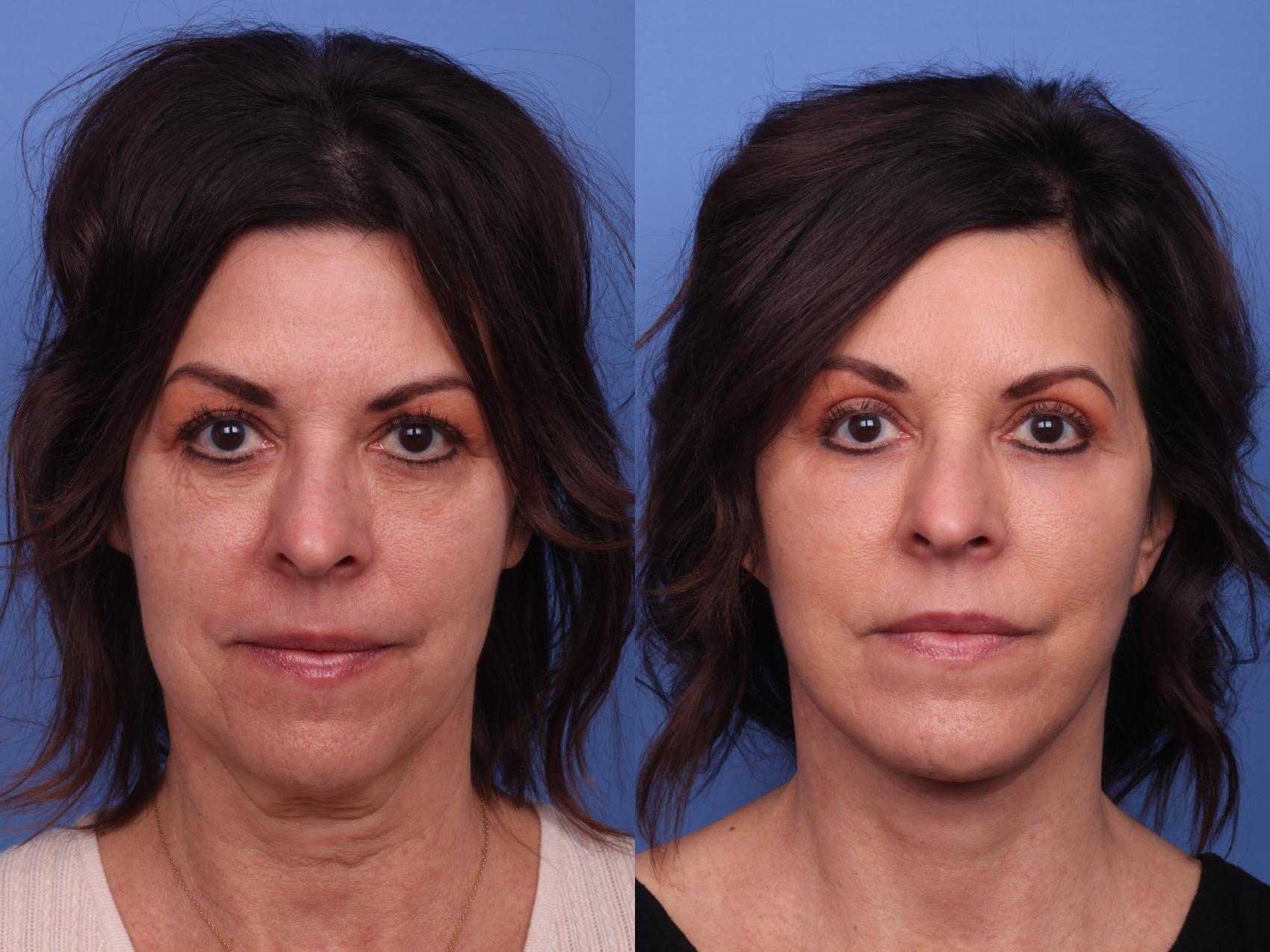Before & After Facelift Case 391 Front View in Scottsdale, AZ