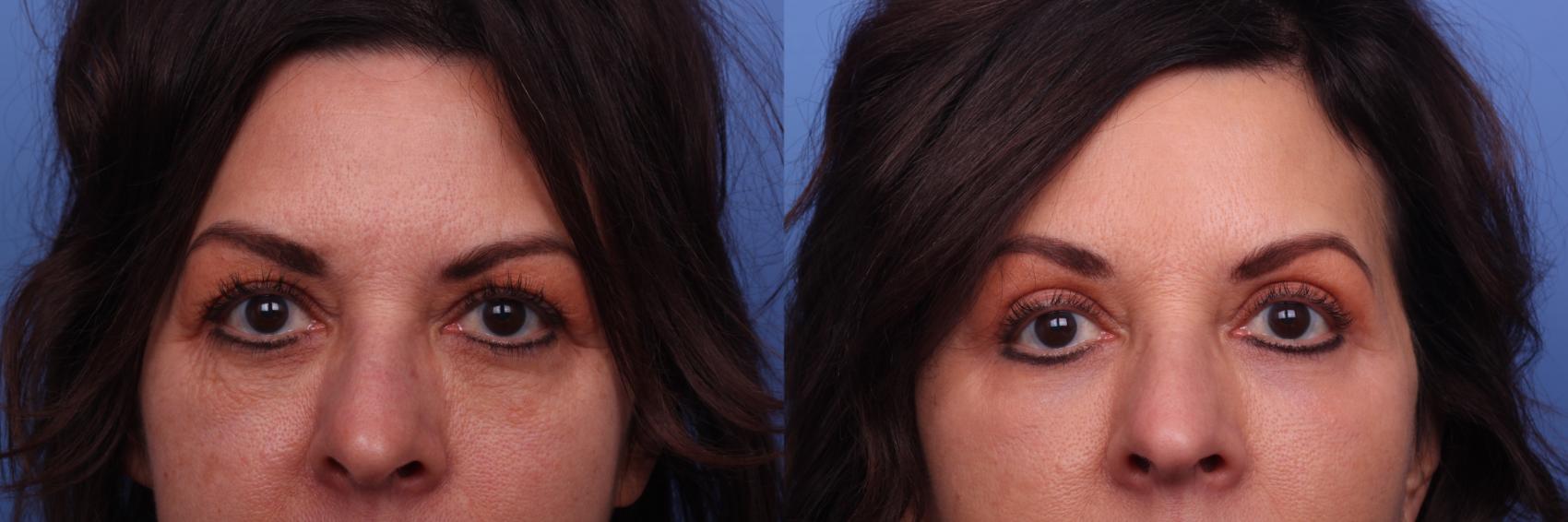 Before & After Facelift Case 391 Zoom Bleph View in Scottsdale, AZ