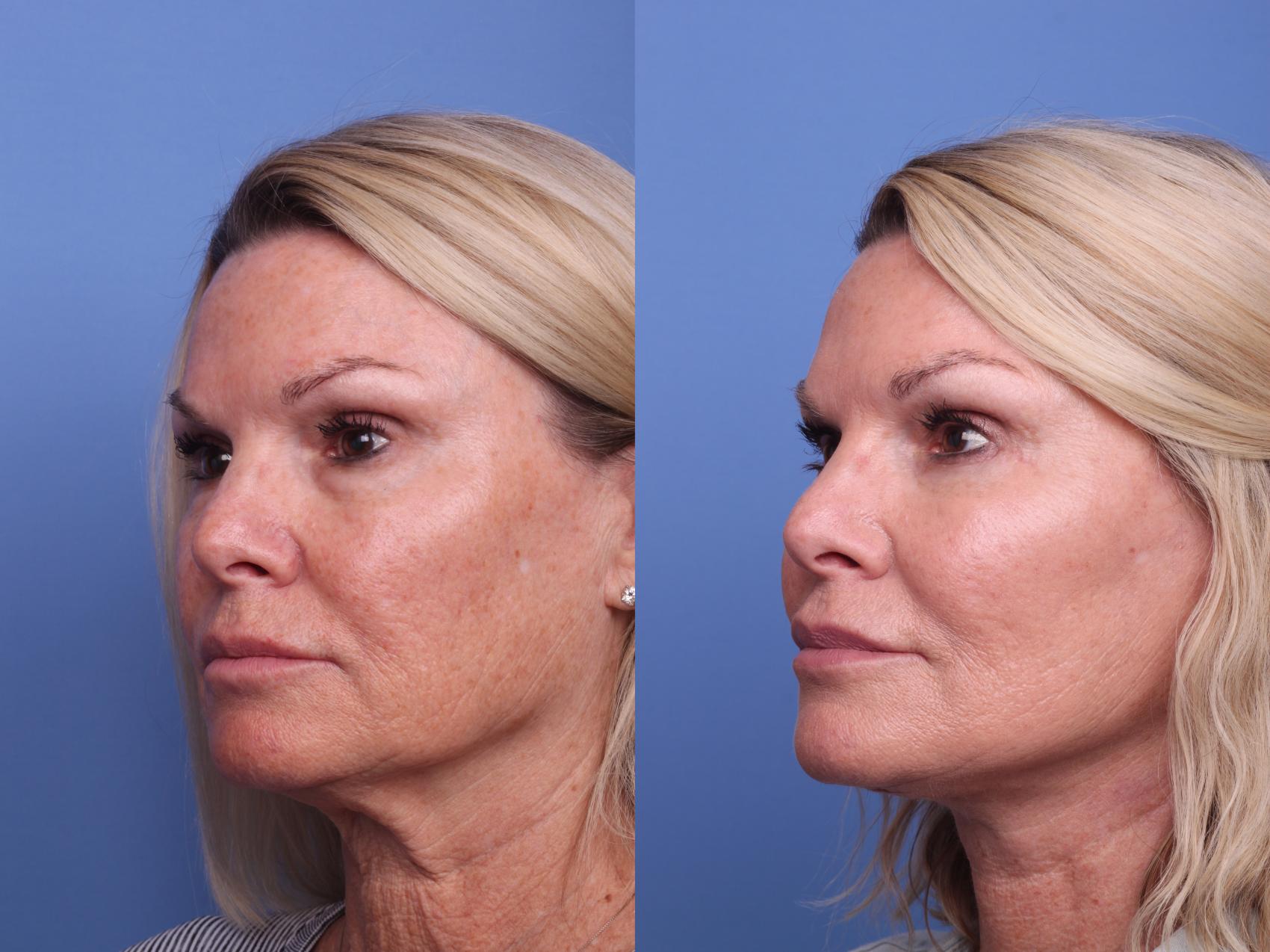 Before & After Facelift Case 399 Left Oblique View in Scottsdale, AZ