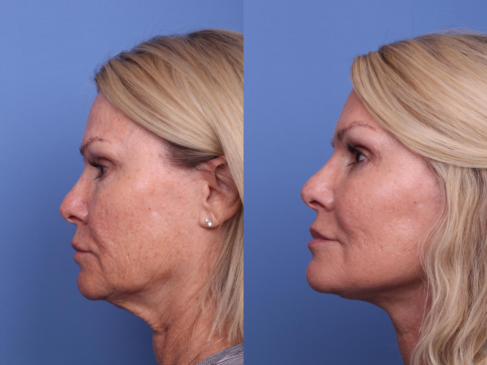 Before & After Facelift Case 399 Left Side View in Scottsdale, AZ