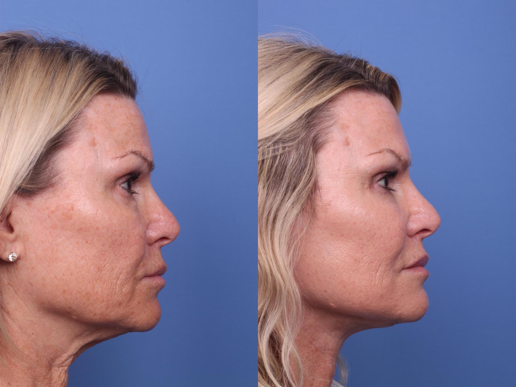 Before & After Facelift Case 399 Right Side View in Scottsdale, AZ