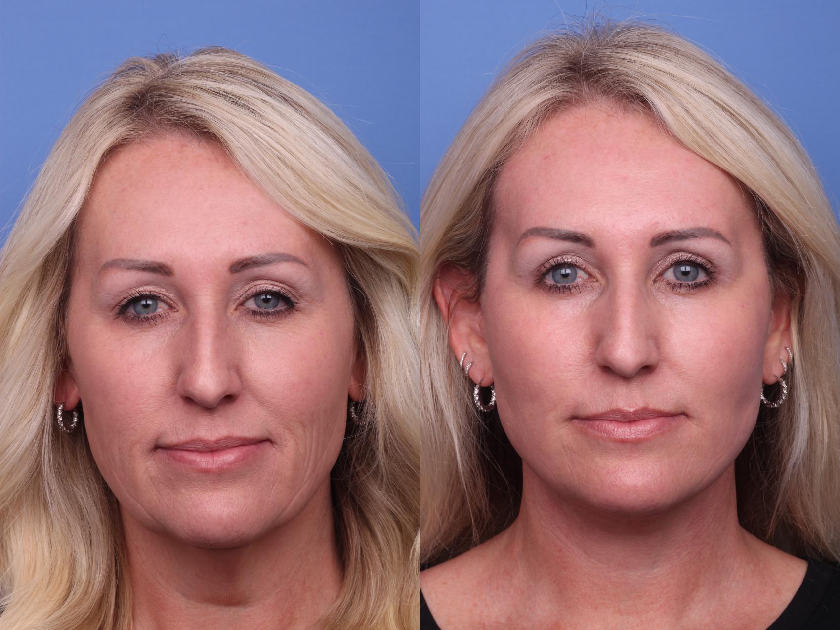 Before & After Facelift Case 403 Front View in Scottsdale, AZ