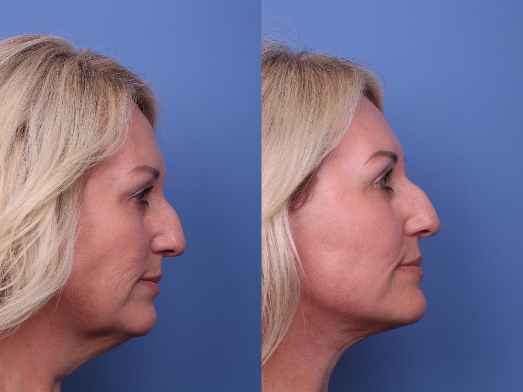 Before & After Facelift Case 403 Right Side View in Scottsdale, AZ