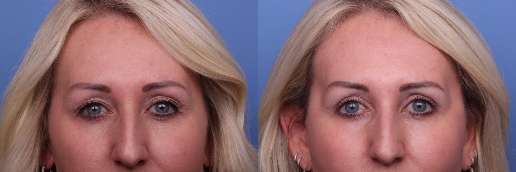 Before & After Facelift Case 403 Zoom Bleph View in Scottsdale, AZ