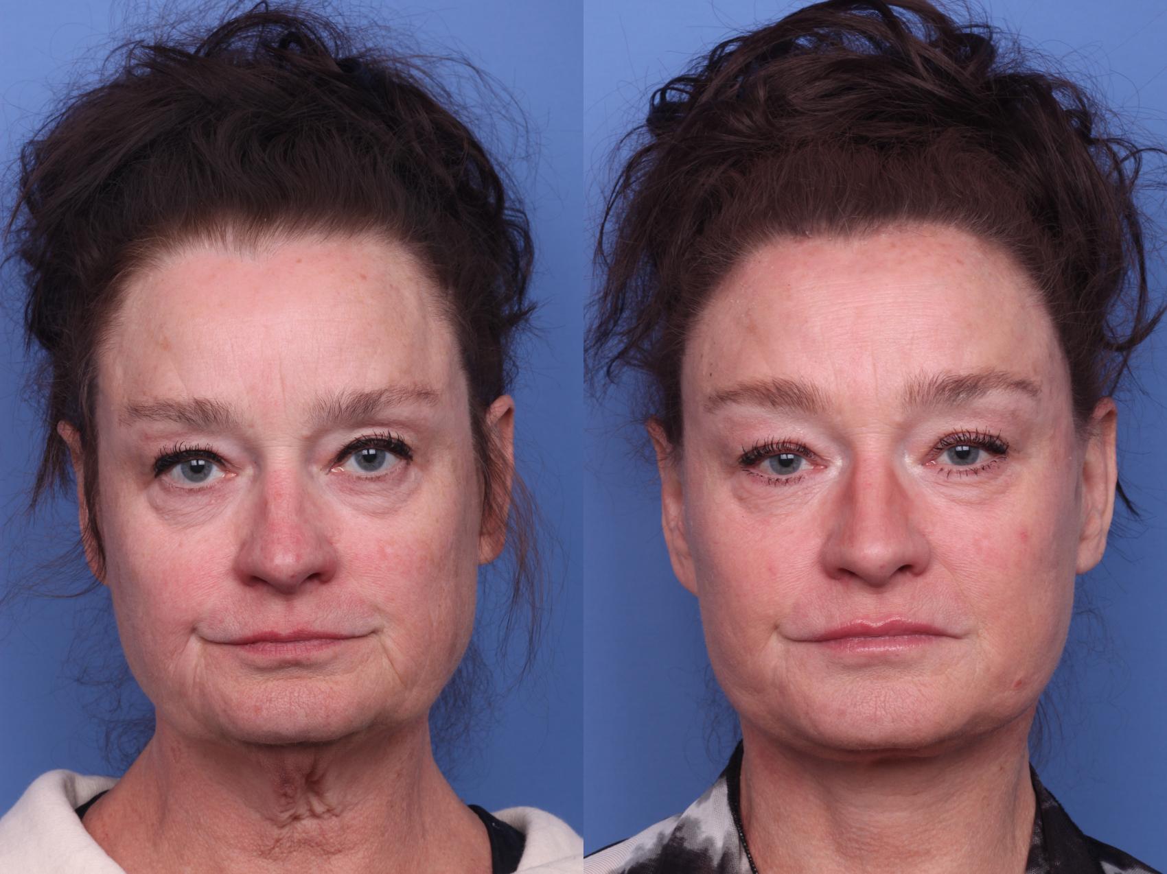 Before & After Facelift Case 415 Front View in Scottsdale, AZ