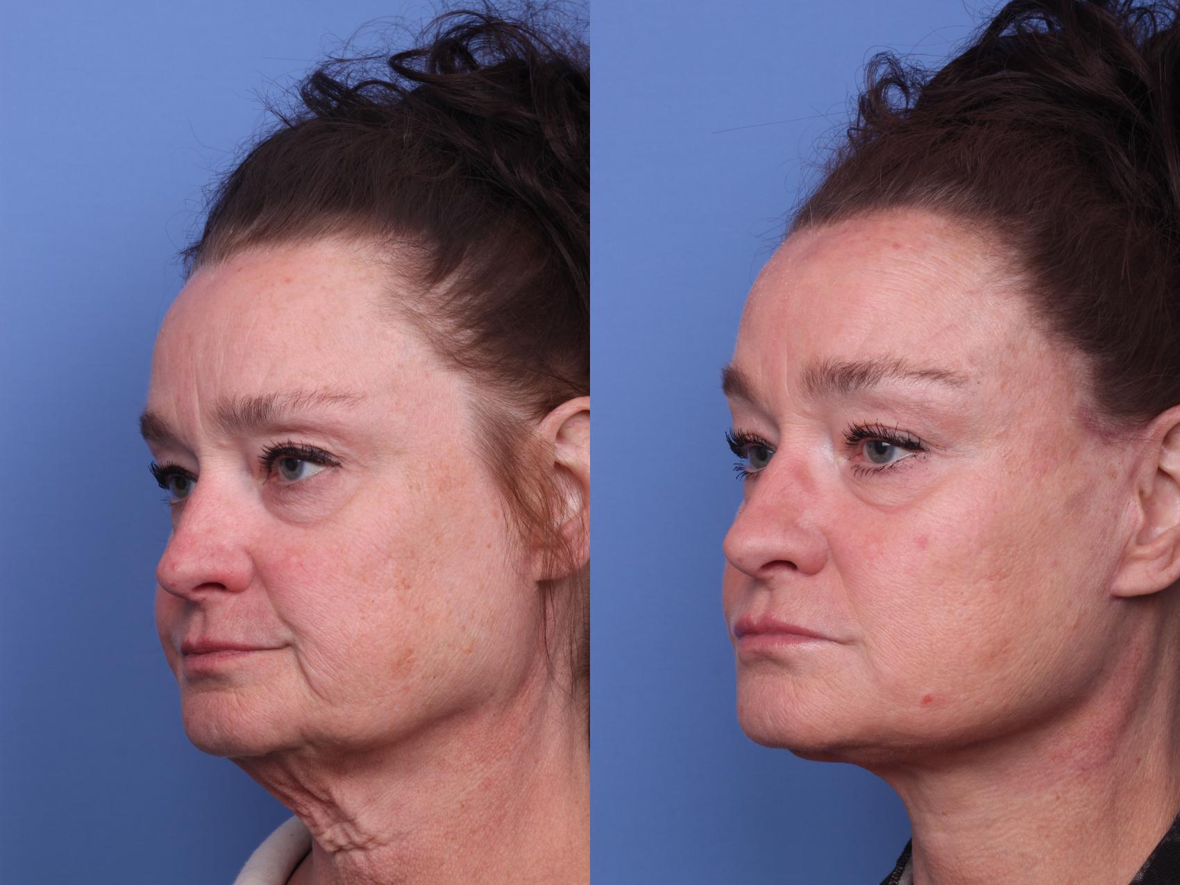 Before & After Facelift Case 415 Left Oblique View in Scottsdale, AZ