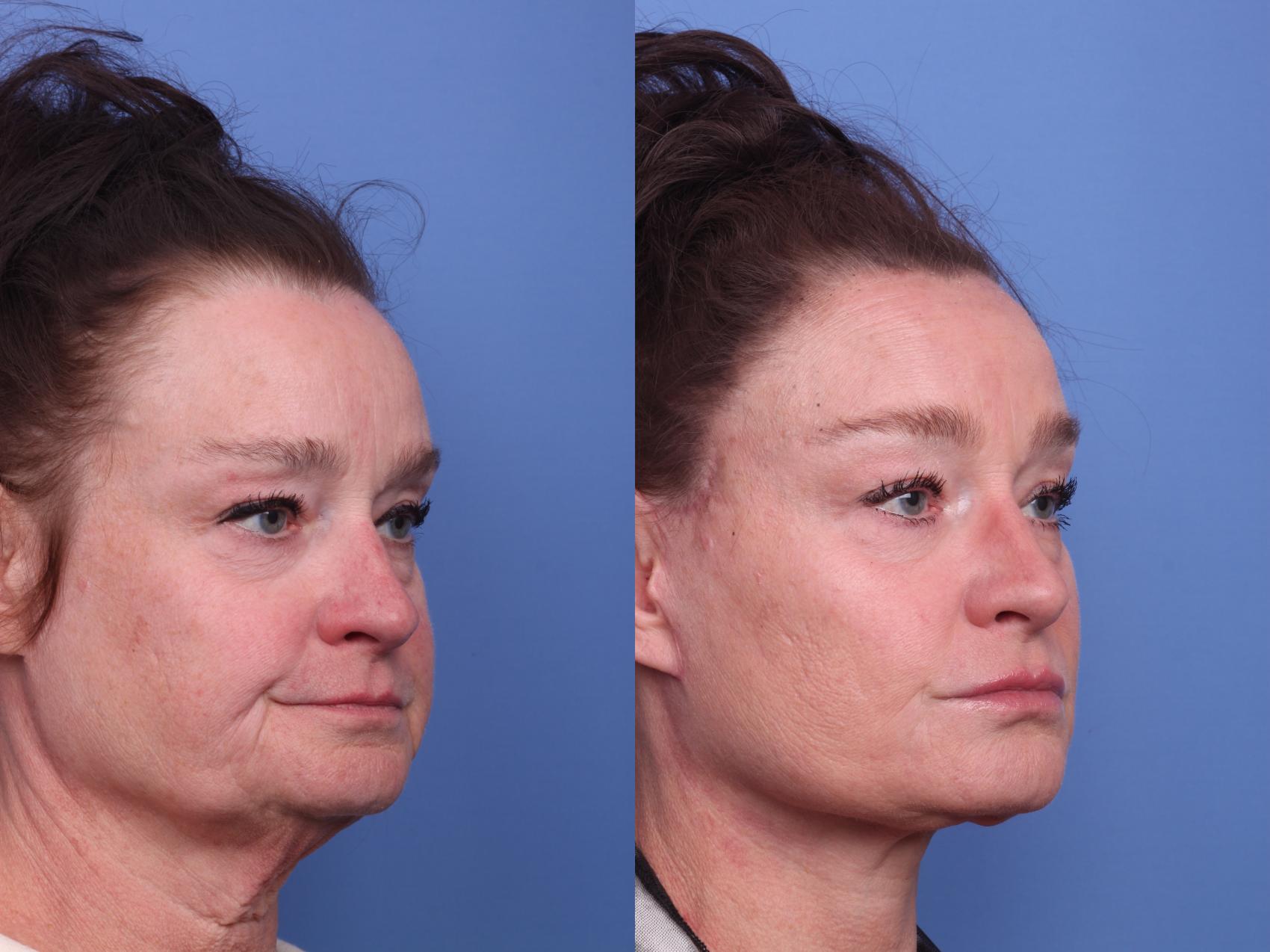 Before & After Facelift Case 415 Right Oblique View in Scottsdale, AZ