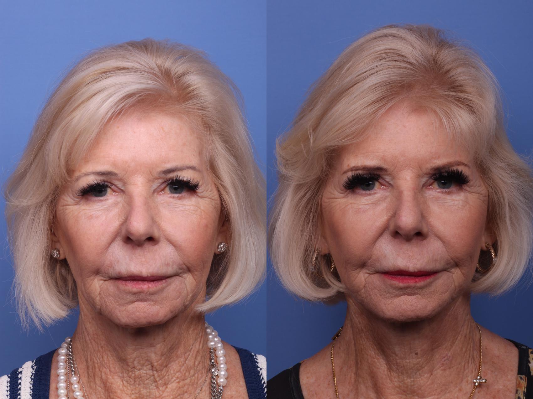 Before & After Facelift Case 419 Front View in Scottsdale, AZ