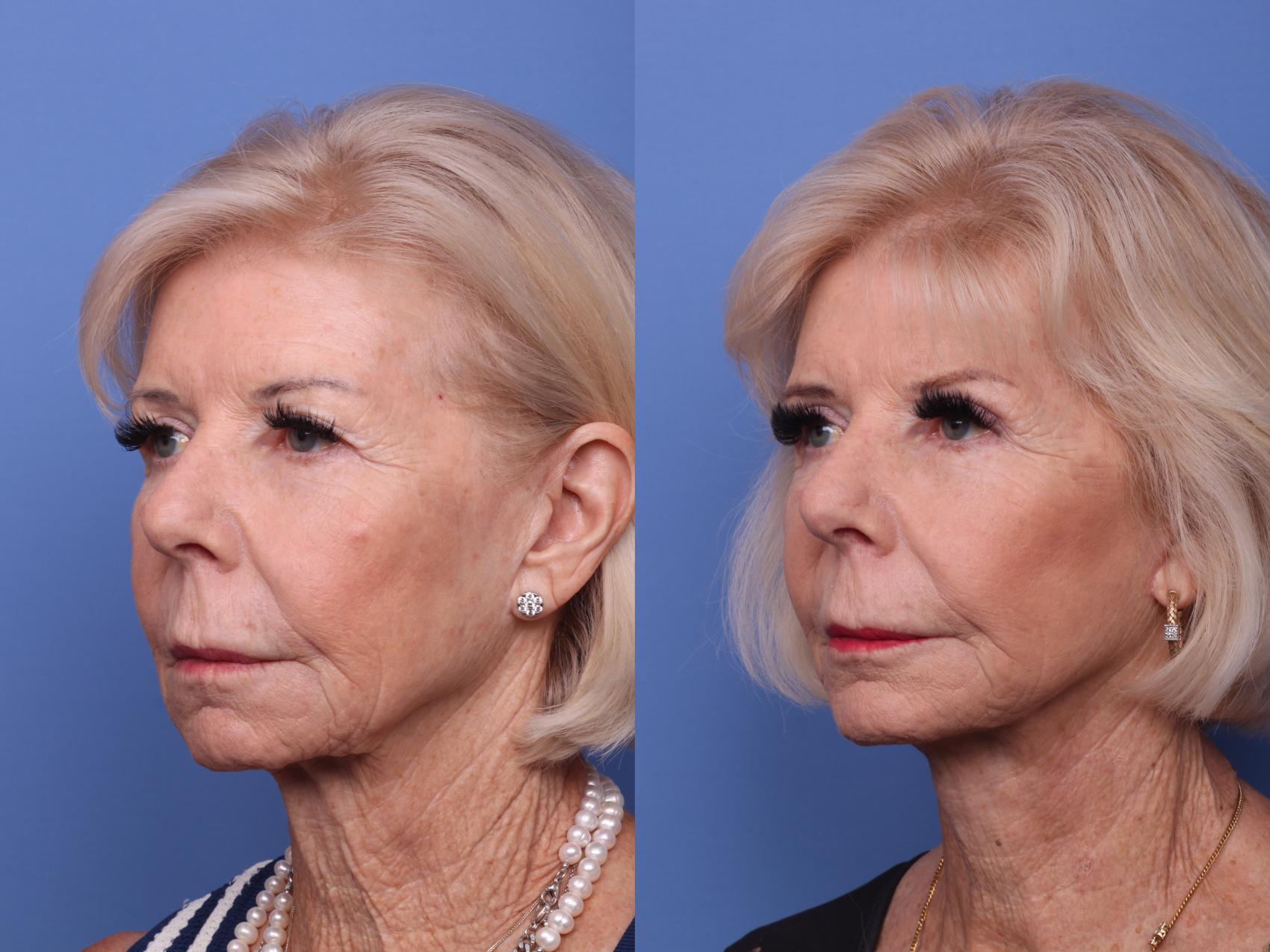 Facelift Before And After Pictures Case 419 Scottsdale Az Hobgood Facial Plastic Surgery