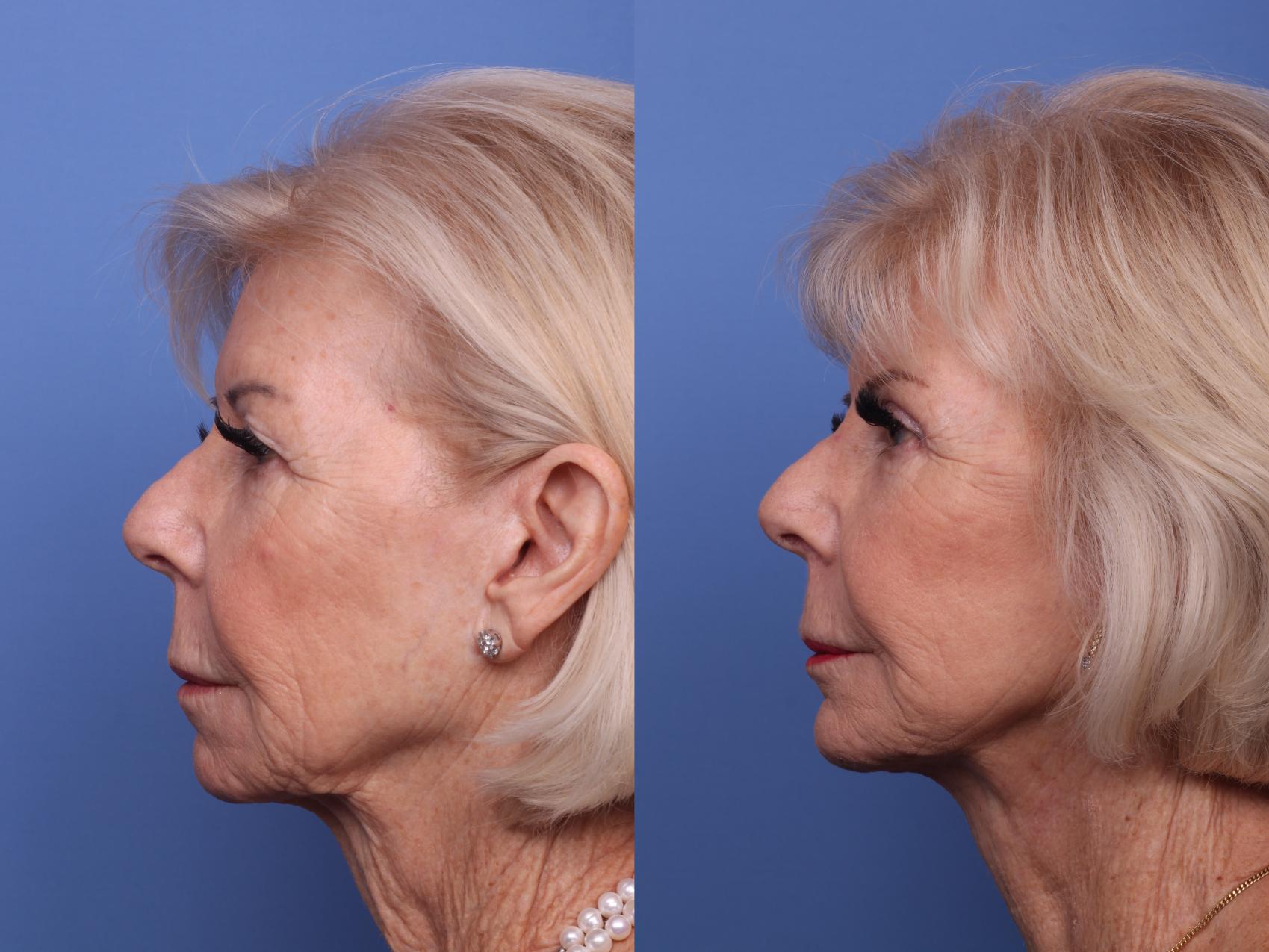 Before & After Facelift Case 419 Left Side View in Scottsdale, AZ