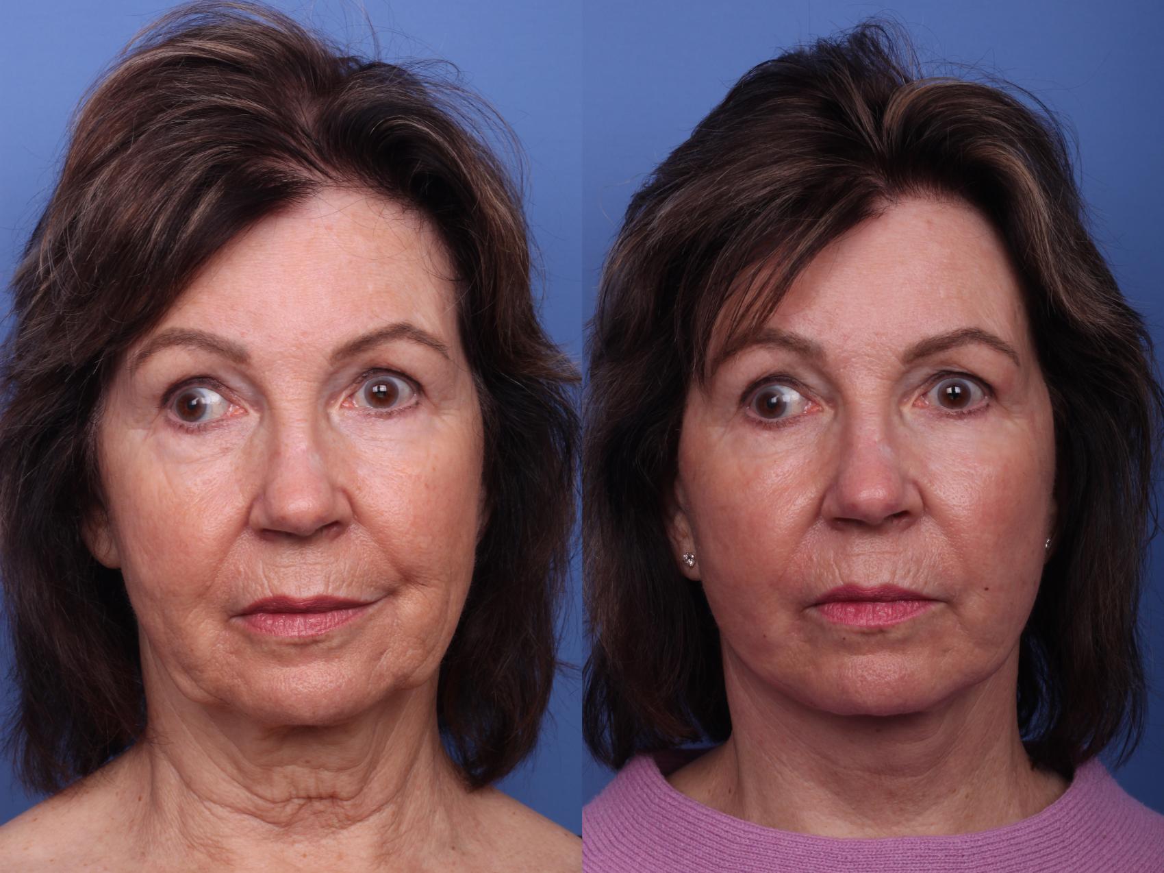 Before & After Facelift Case 429 Front View in Scottsdale, AZ