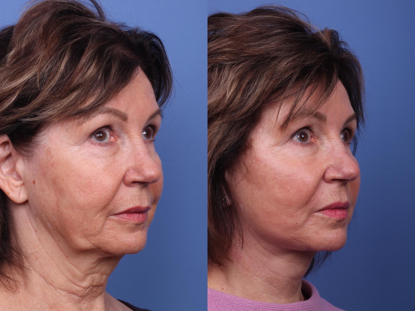 Before & After Facelift Case 429 Right Oblique View in Scottsdale, AZ