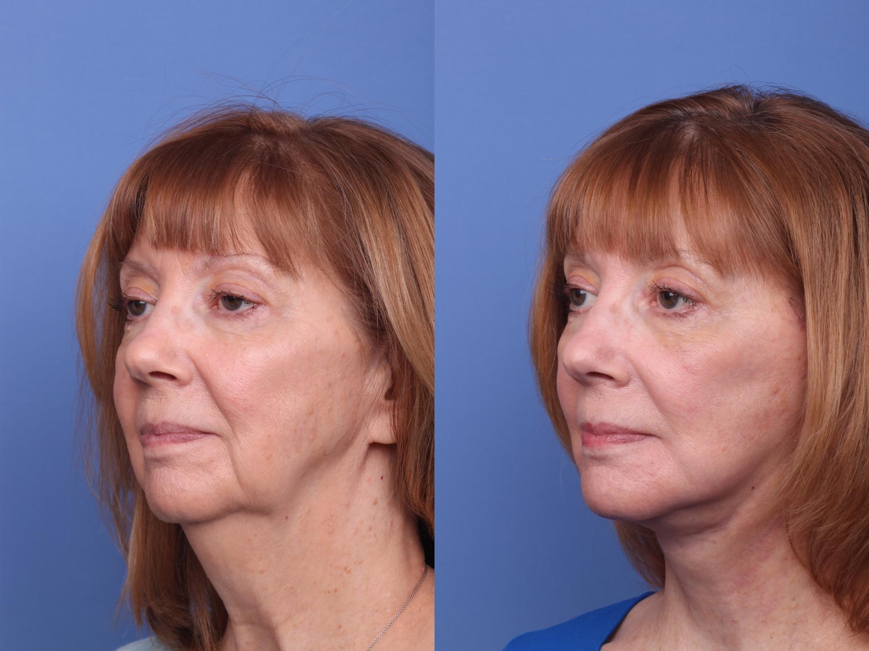 Facelift Before and After Pictures Case 431 | Scottsdale & Phoenix, AZ ...