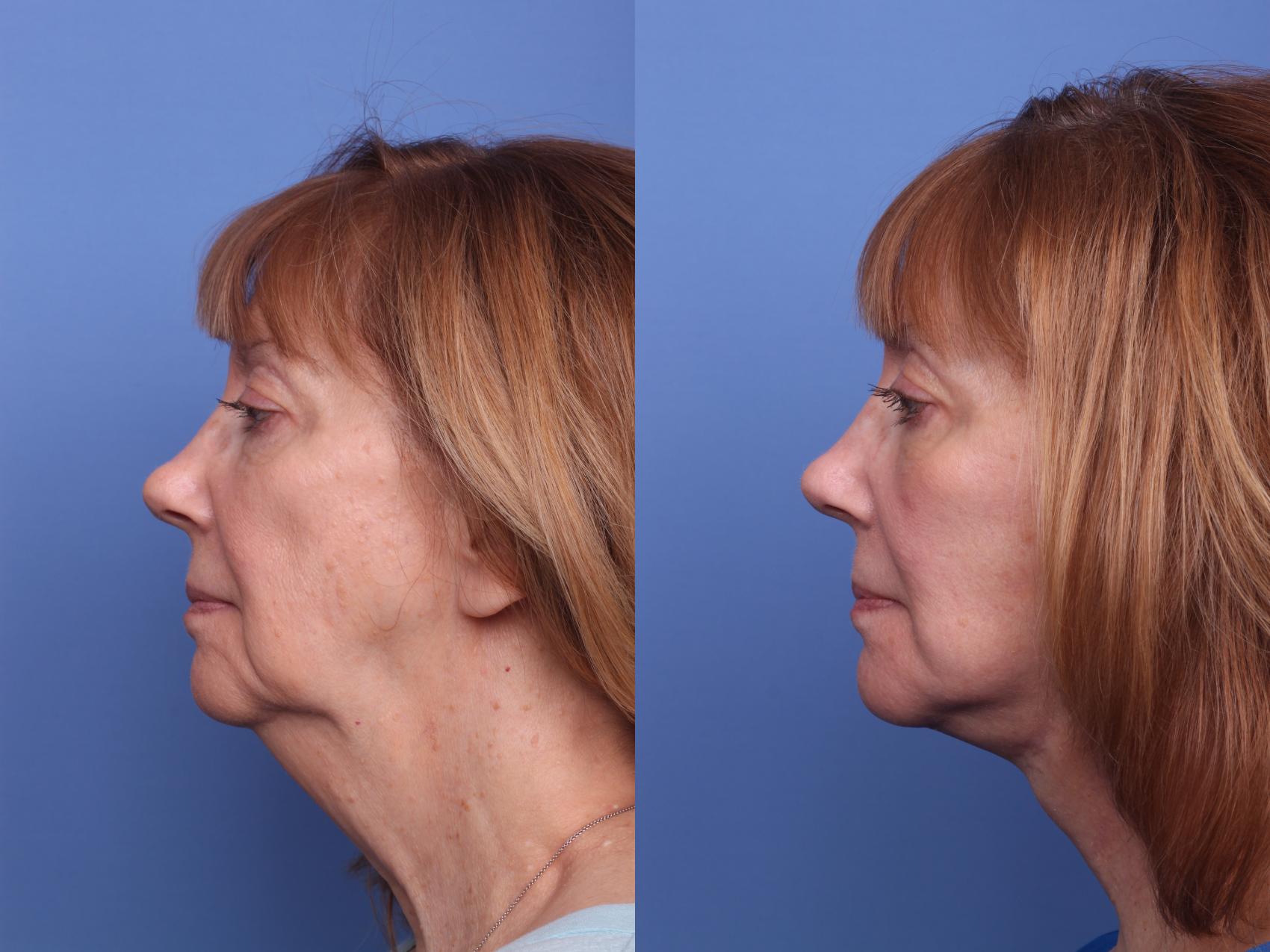 Before & After Facelift Case 431 Left Side View in Scottsdale, AZ