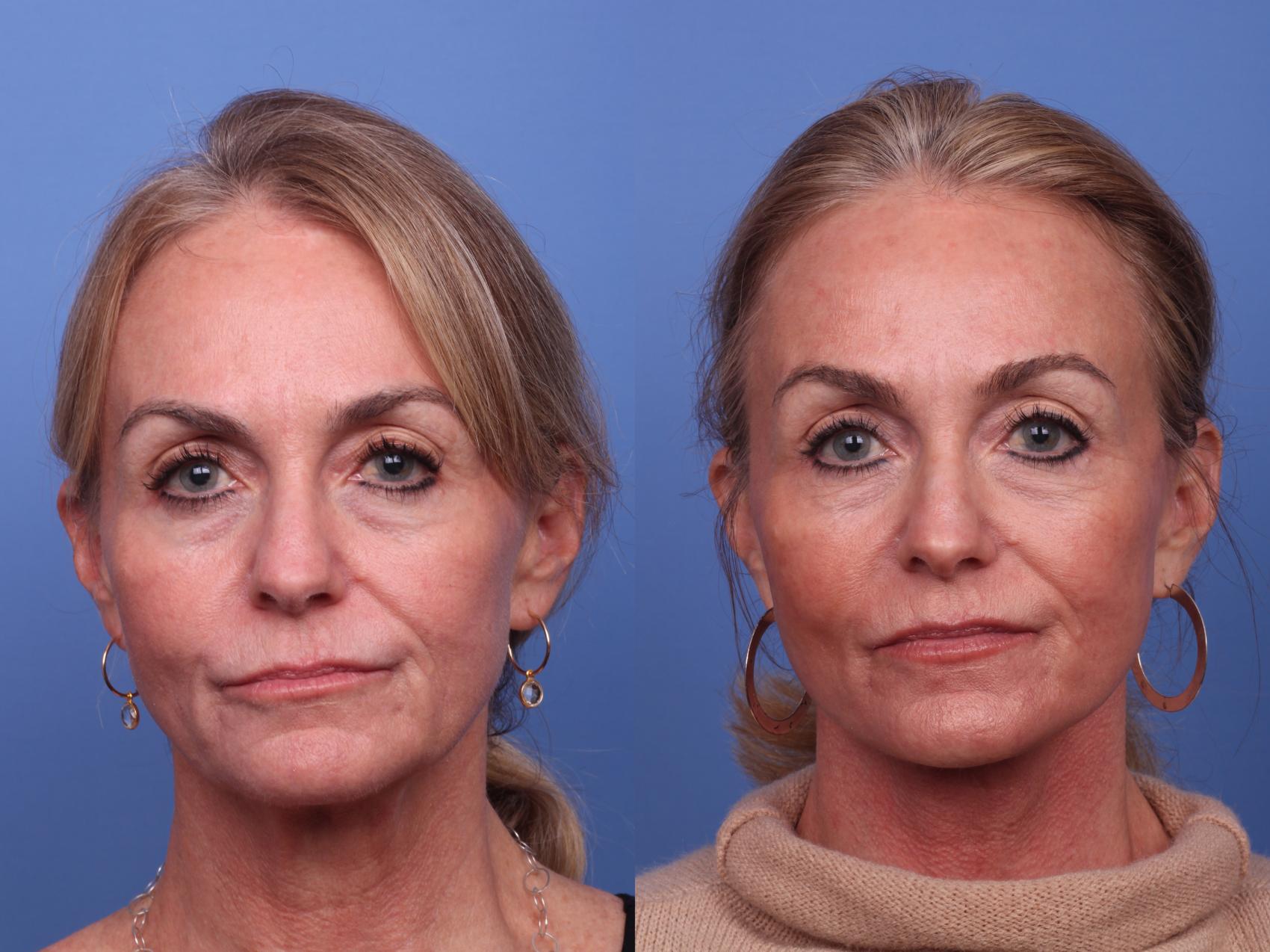 Facelift Before & After Photo | Scottsdale & Phoenix, AZ | Hobgood Facial Plastic Surgery: Todd Hobgood, MD