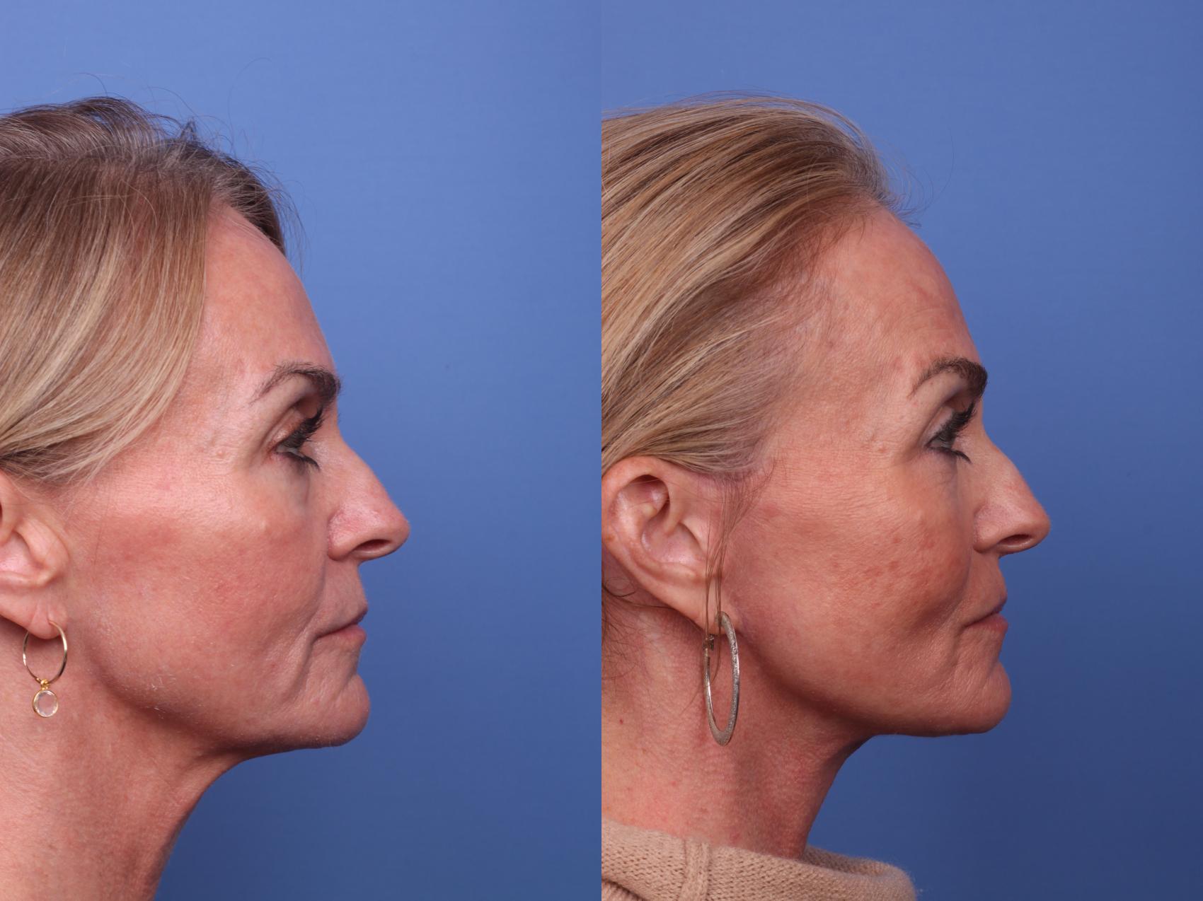 Before & After Facelift Case 456 Right Side View in Scottsdale, AZ