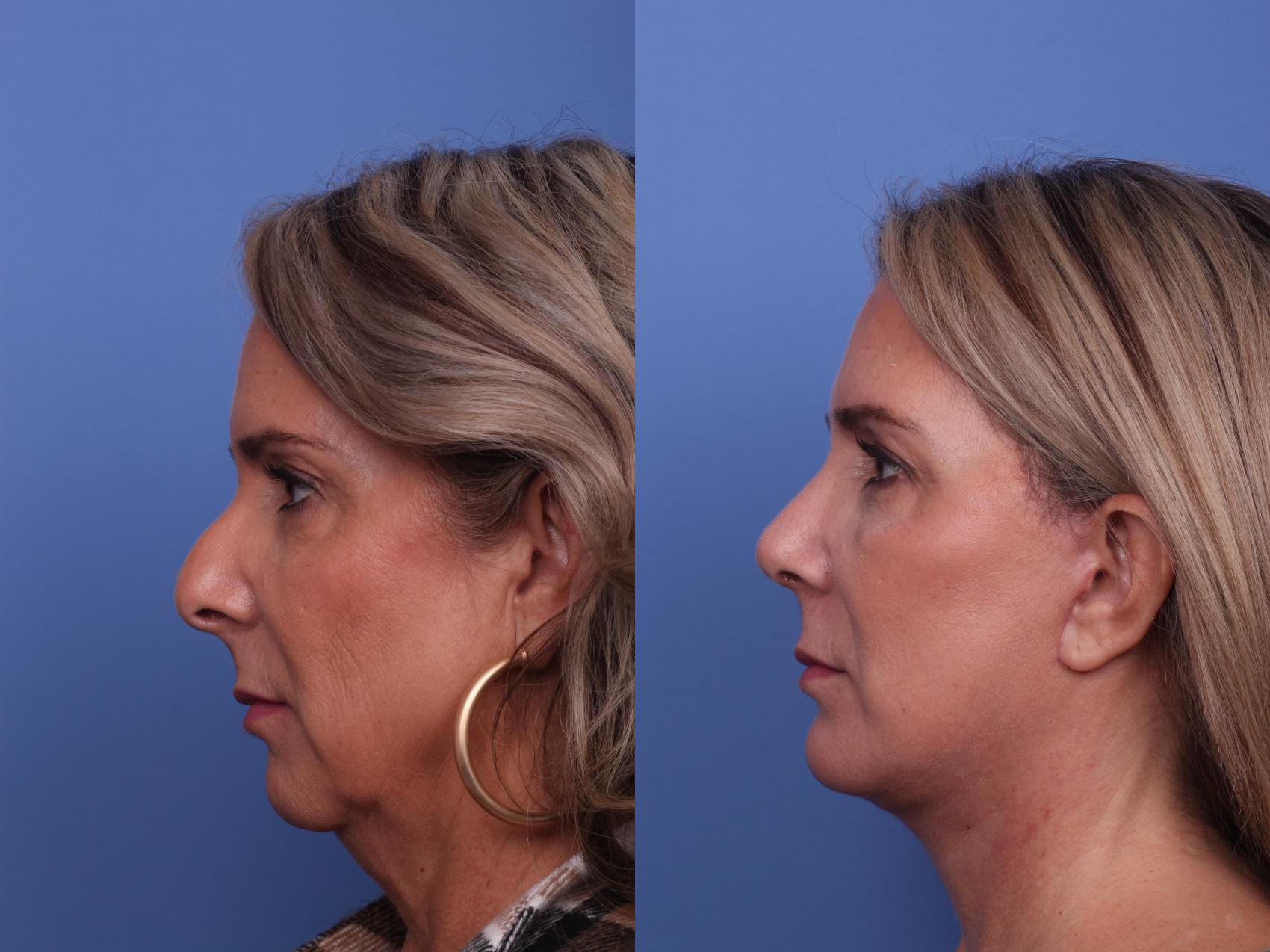 Does Facelift Surgery Gives You a Wrinkle Free Face?