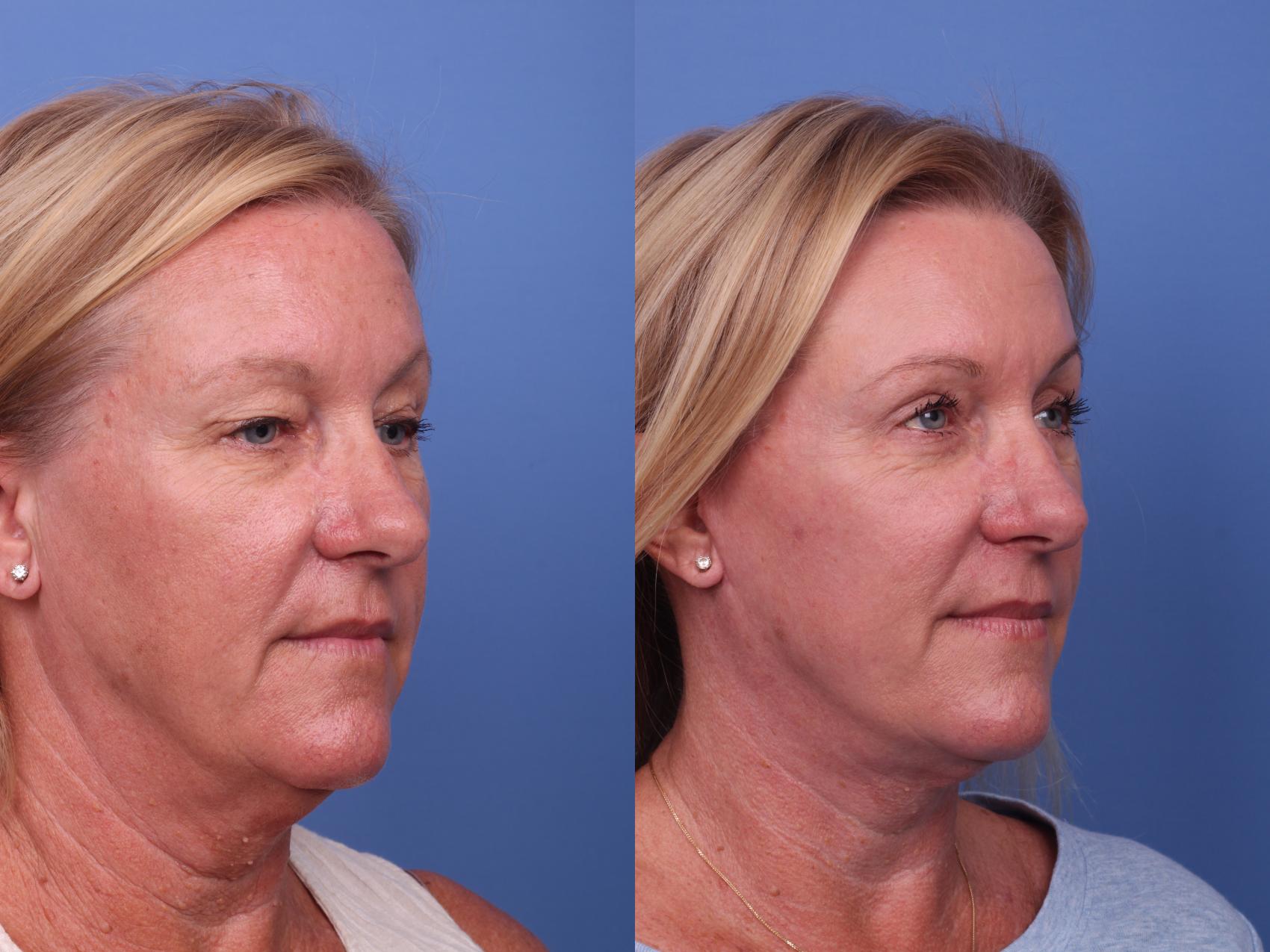 Before & After Facelift Case 460 Right Oblique View in Scottsdale, AZ