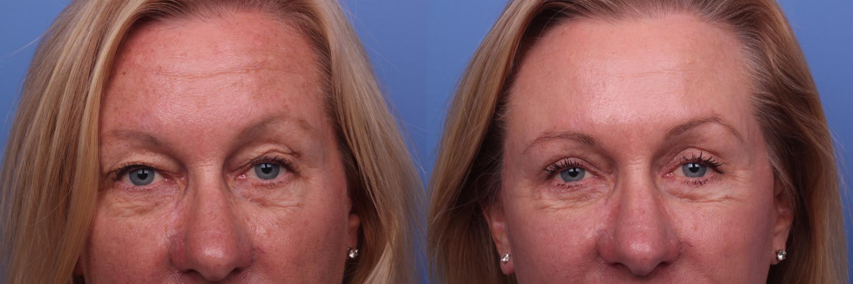 Before & After Facelift Case 460 Zoom Bleph View in Scottsdale, AZ