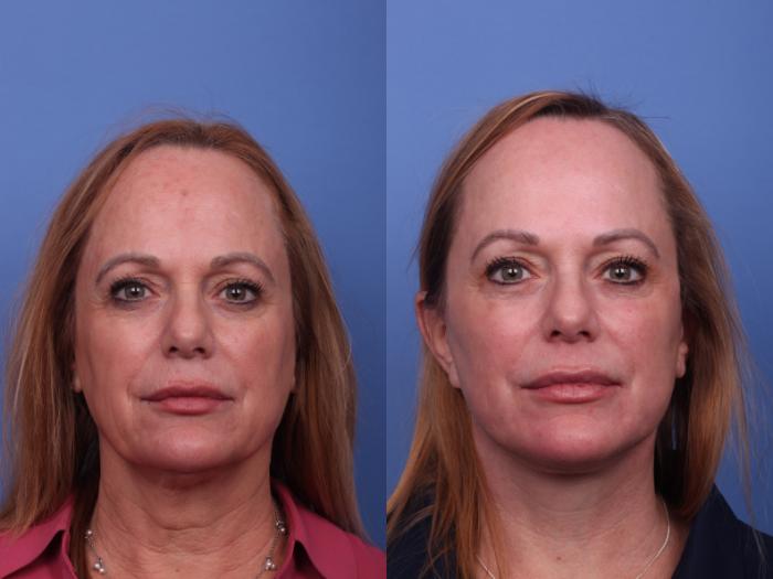 CO2 Laser Resurfacing (under anesthesia) Before & After Photo | Scottsdale & Phoenix, AZ | Hobgood Facial Plastic Surgery: Todd Hobgood, MD