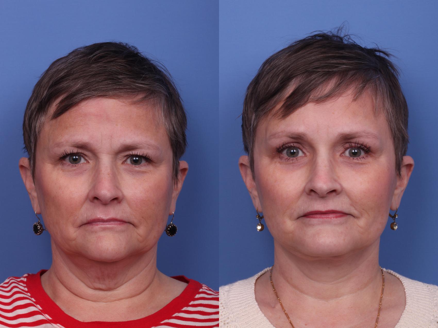 Brow Lift Before & After Photo | Scottsdale & Phoenix, AZ | Hobgood Facial Plastic Surgery: Todd Hobgood, MD