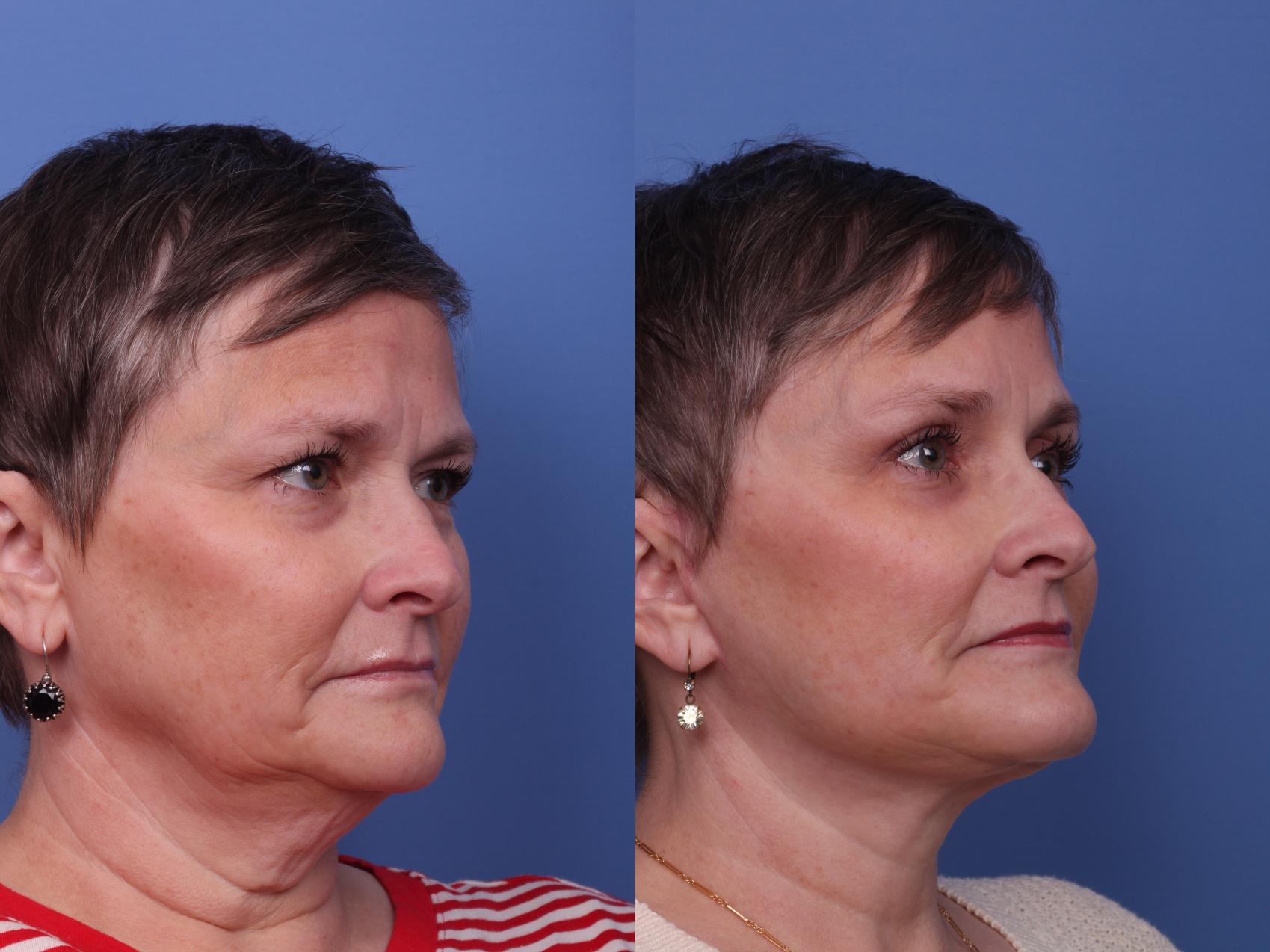 Facelift Before & After Photo | Scottsdale & Phoenix, AZ | Hobgood Facial Plastic Surgery: Todd Hobgood, MD