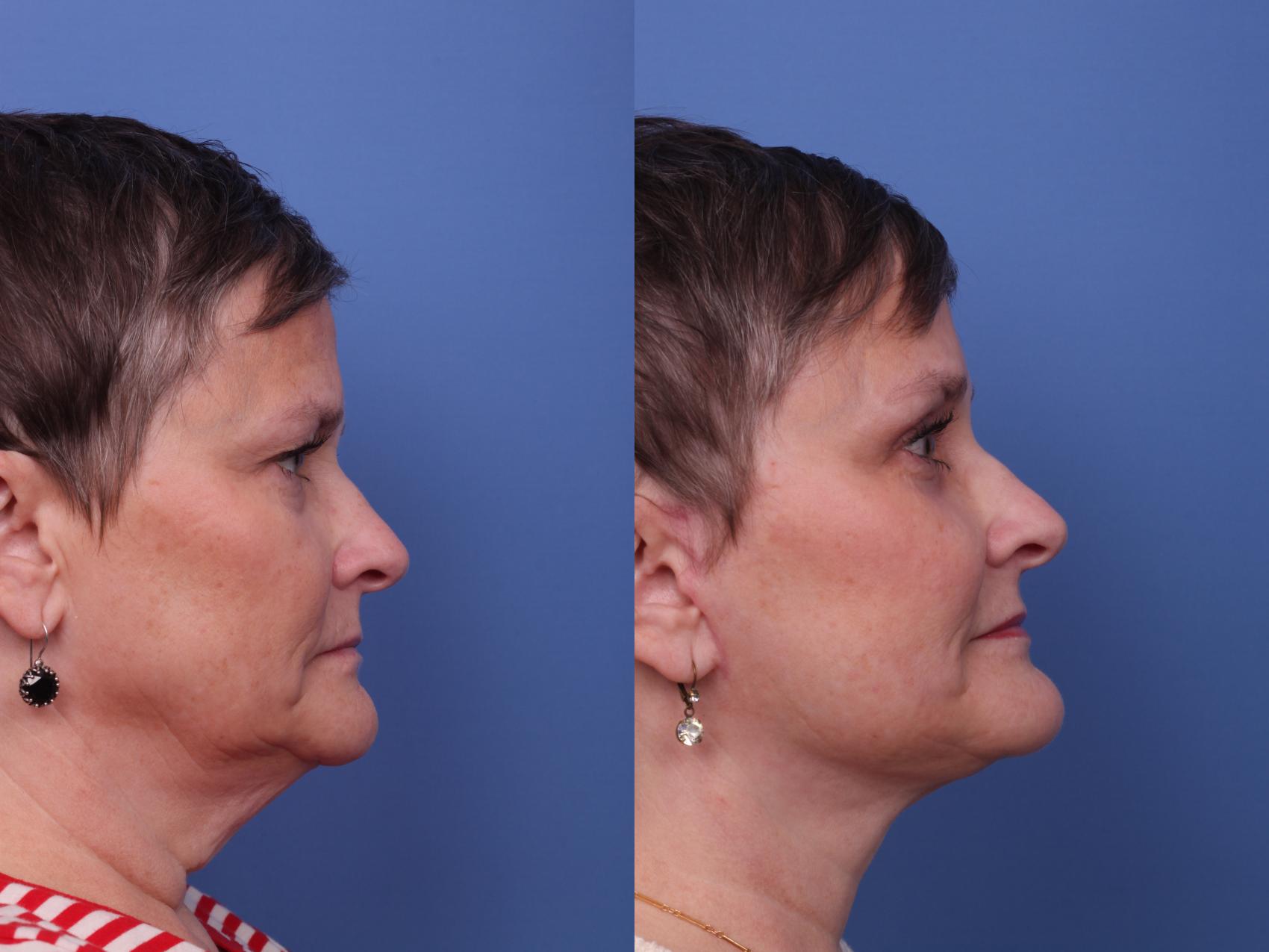 Before & After Facelift Case 478 Right Side View in Scottsdale, AZ