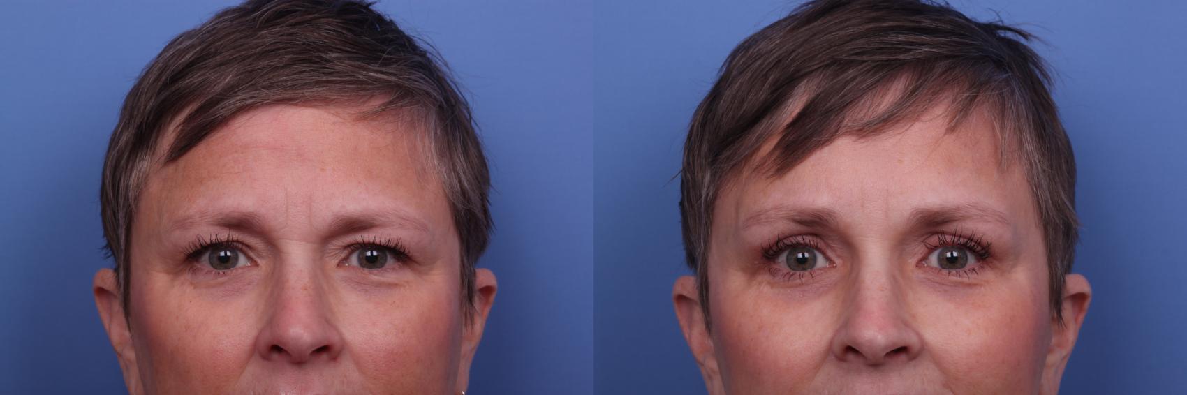 Before & After Facelift Case 478 Zoom Bleph View in Scottsdale, AZ