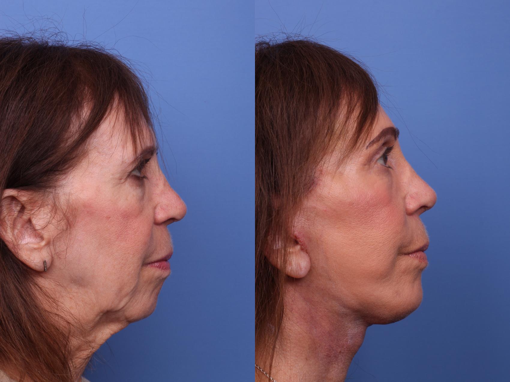 Before & After Facelift Case 488 Right Side View in Scottsdale, AZ