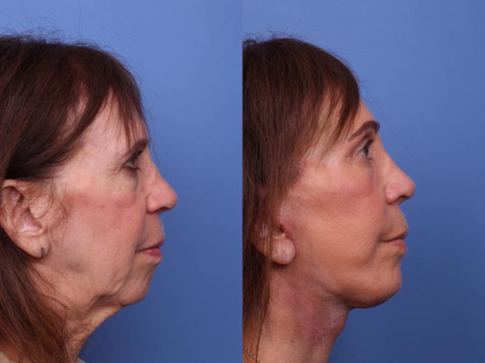 Chin Implant Before & After Photo | Scottsdale & Phoenix, AZ | Hobgood Facial Plastic Surgery: Todd Hobgood, MD