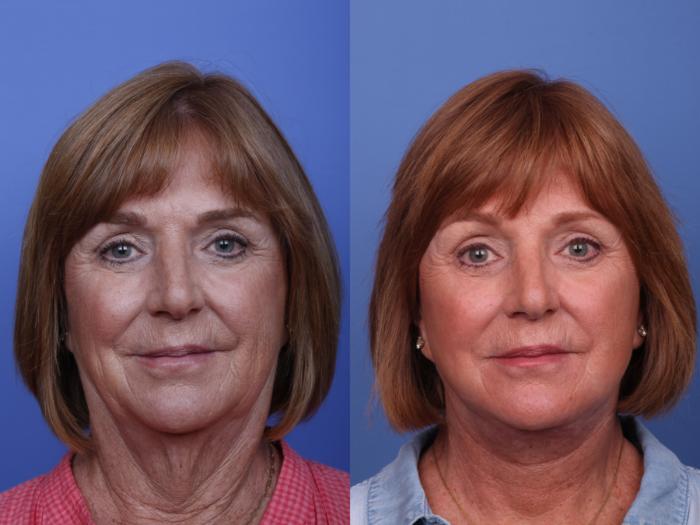 Brow Lift Before & After Photo | Scottsdale, AZ | Hobgood Facial Plastic Surgery: Todd Hobgood, MD