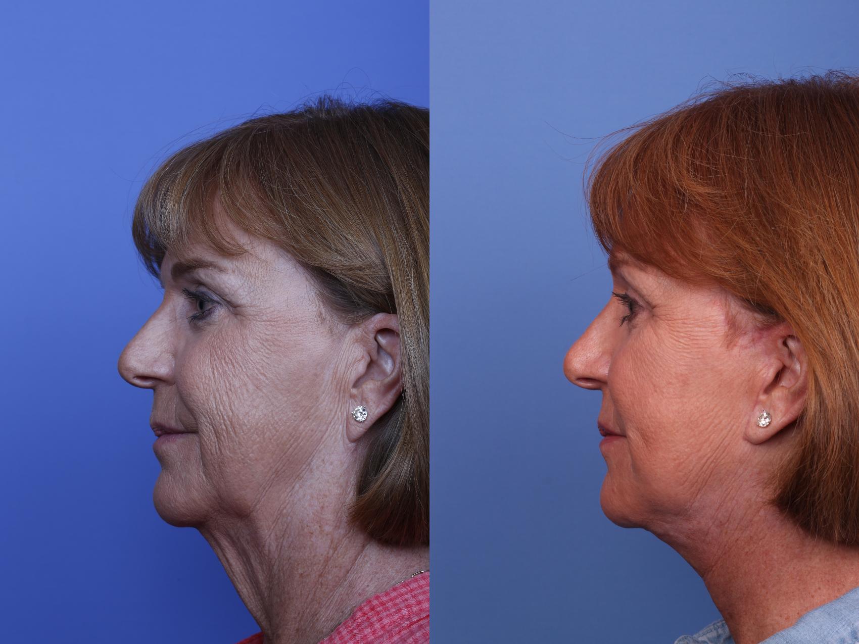 Before & After Facelift Case 502 Left Side View in Scottsdale, AZ