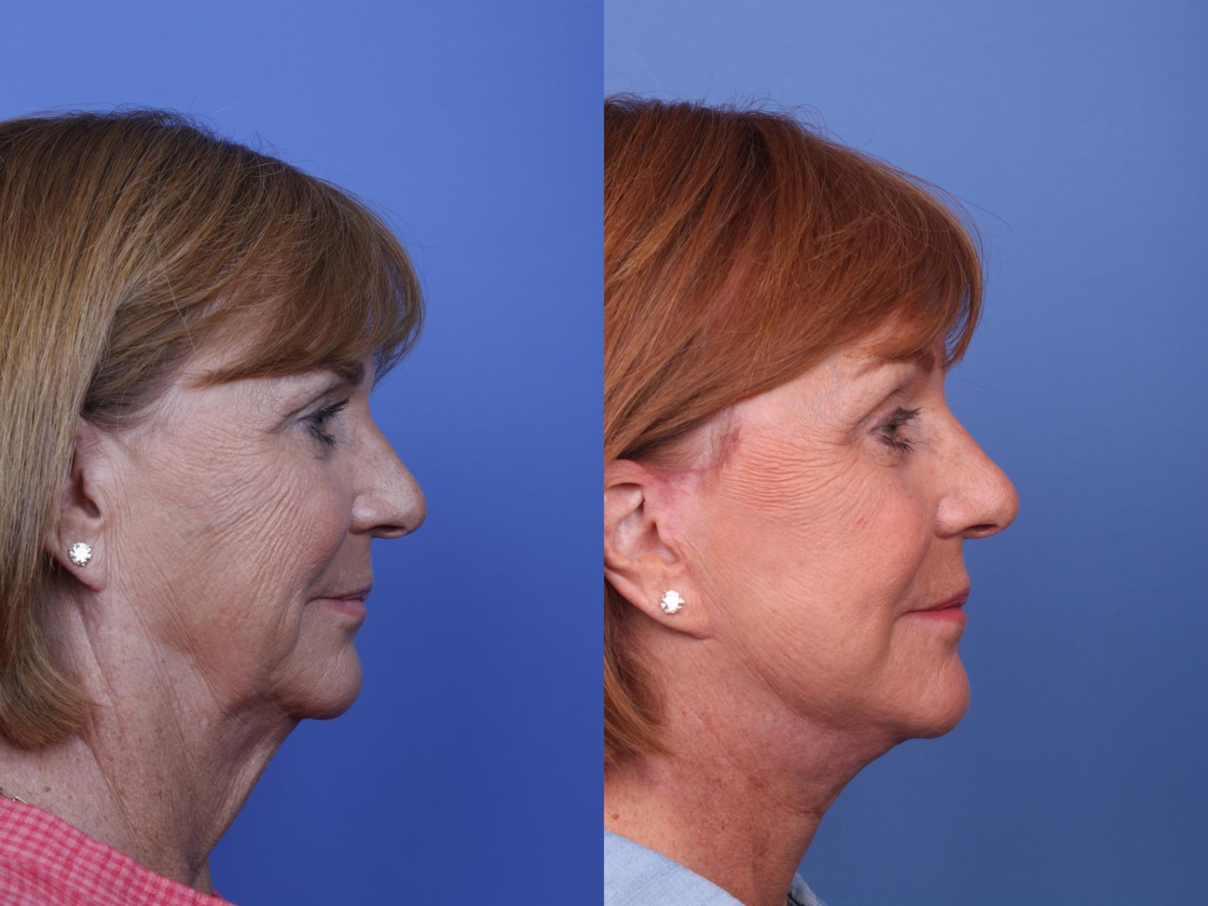 Before & After Facelift Case 502 Right Side View in Scottsdale, AZ