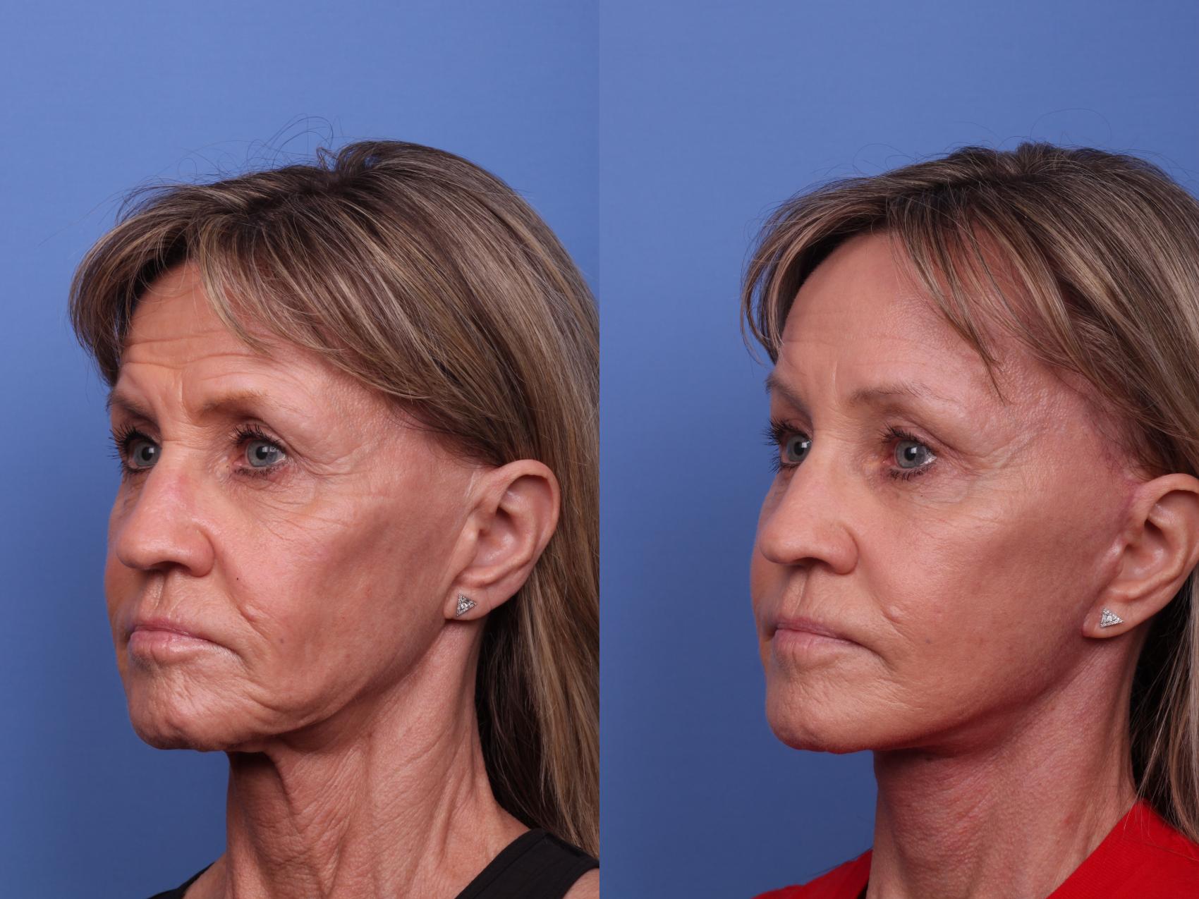 Before & After Facelift Case 506 Left Oblique View in Scottsdale, AZ