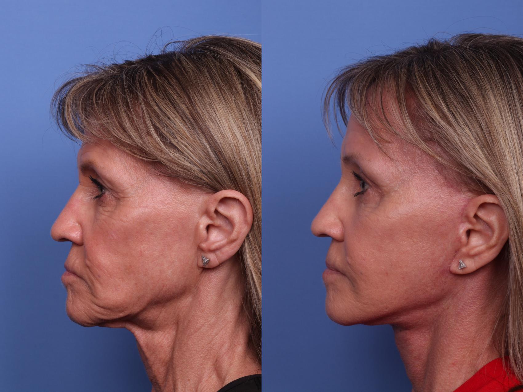 Before & After Facelift Case 506 Left Side View in Scottsdale, AZ
