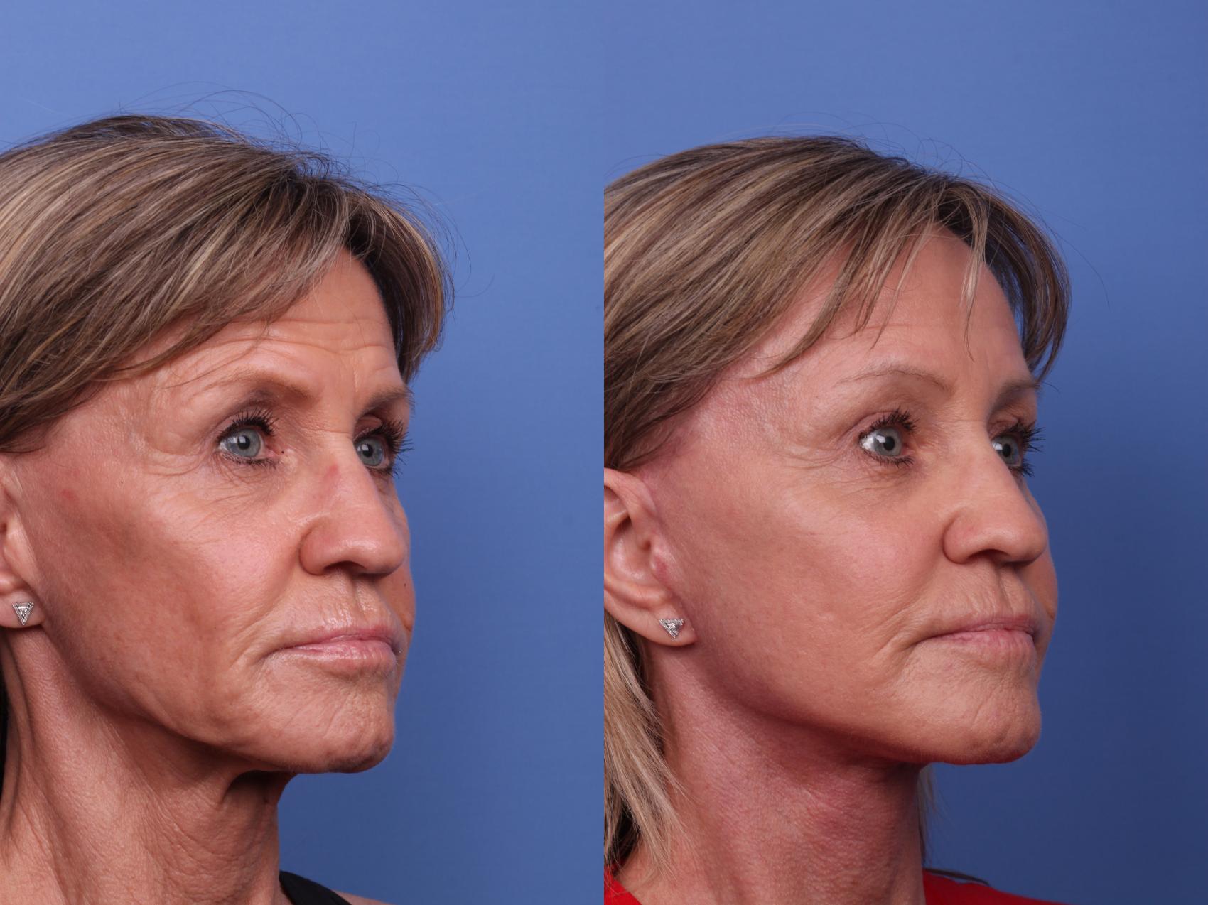 Before & After Facelift Case 506 Right Oblique View in Scottsdale, AZ