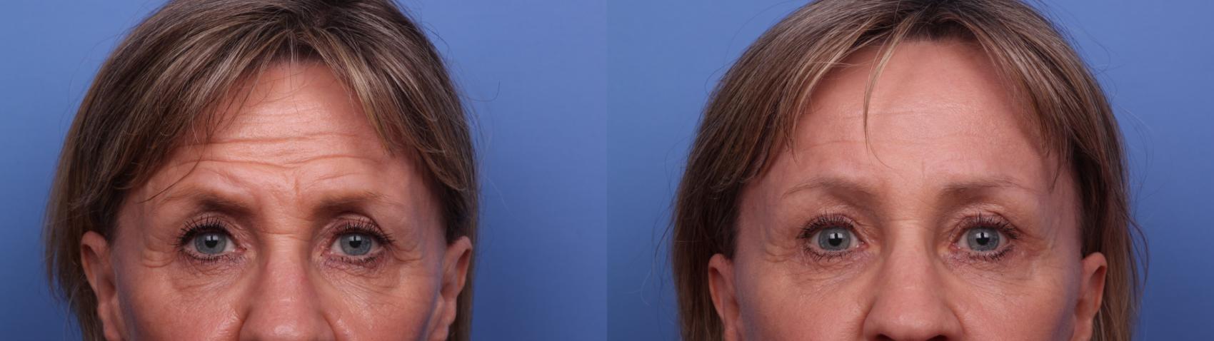 Before & After Facelift Case 506 Zoom Bleph View in Scottsdale, AZ