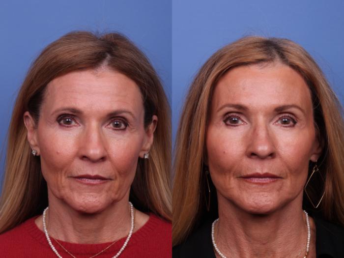CO2 Laser Resurfacing (under anesthesia) Before & After Photo | Scottsdale, AZ | Hobgood Facial Plastic Surgery: Todd Hobgood, MD