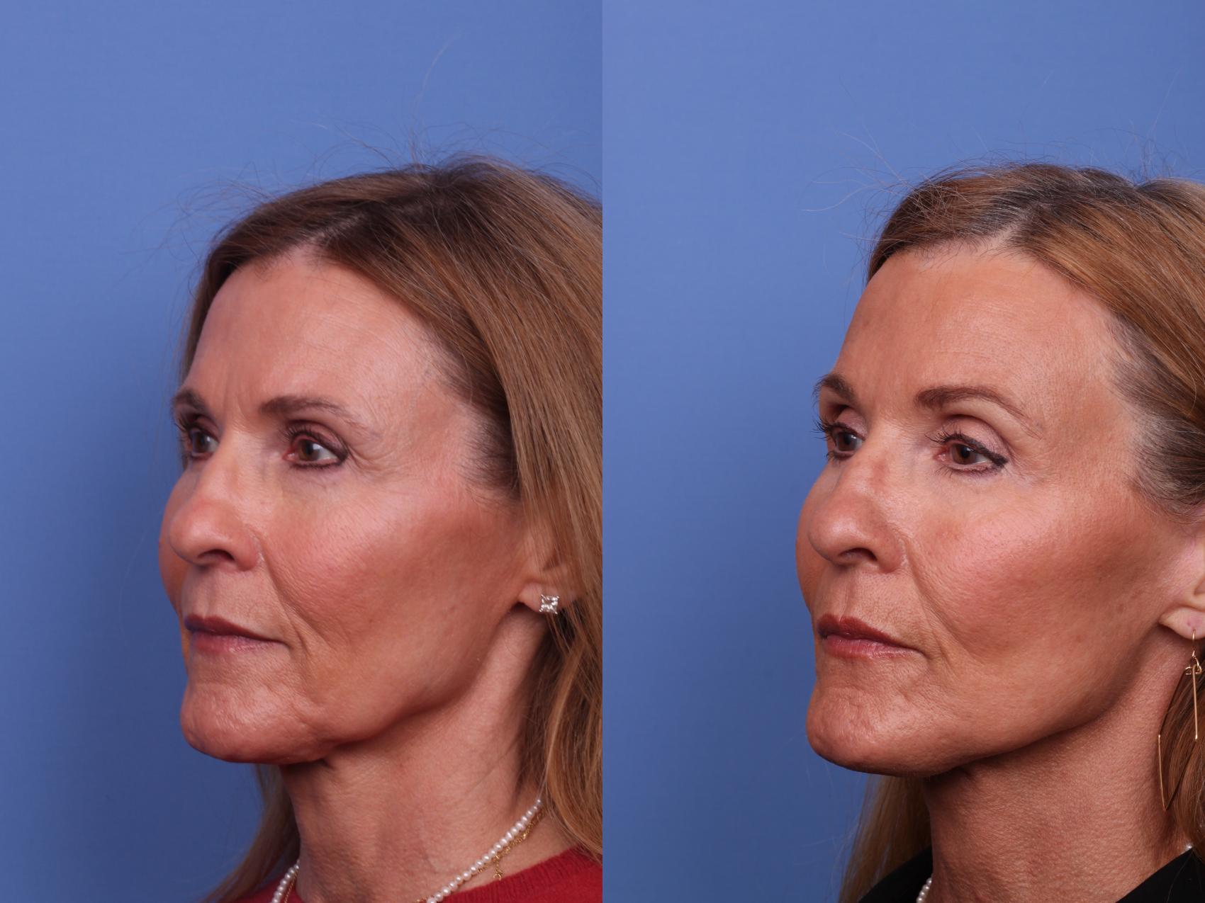 Before & After Facelift Case 515 Right Oblique View in Scottsdale, AZ