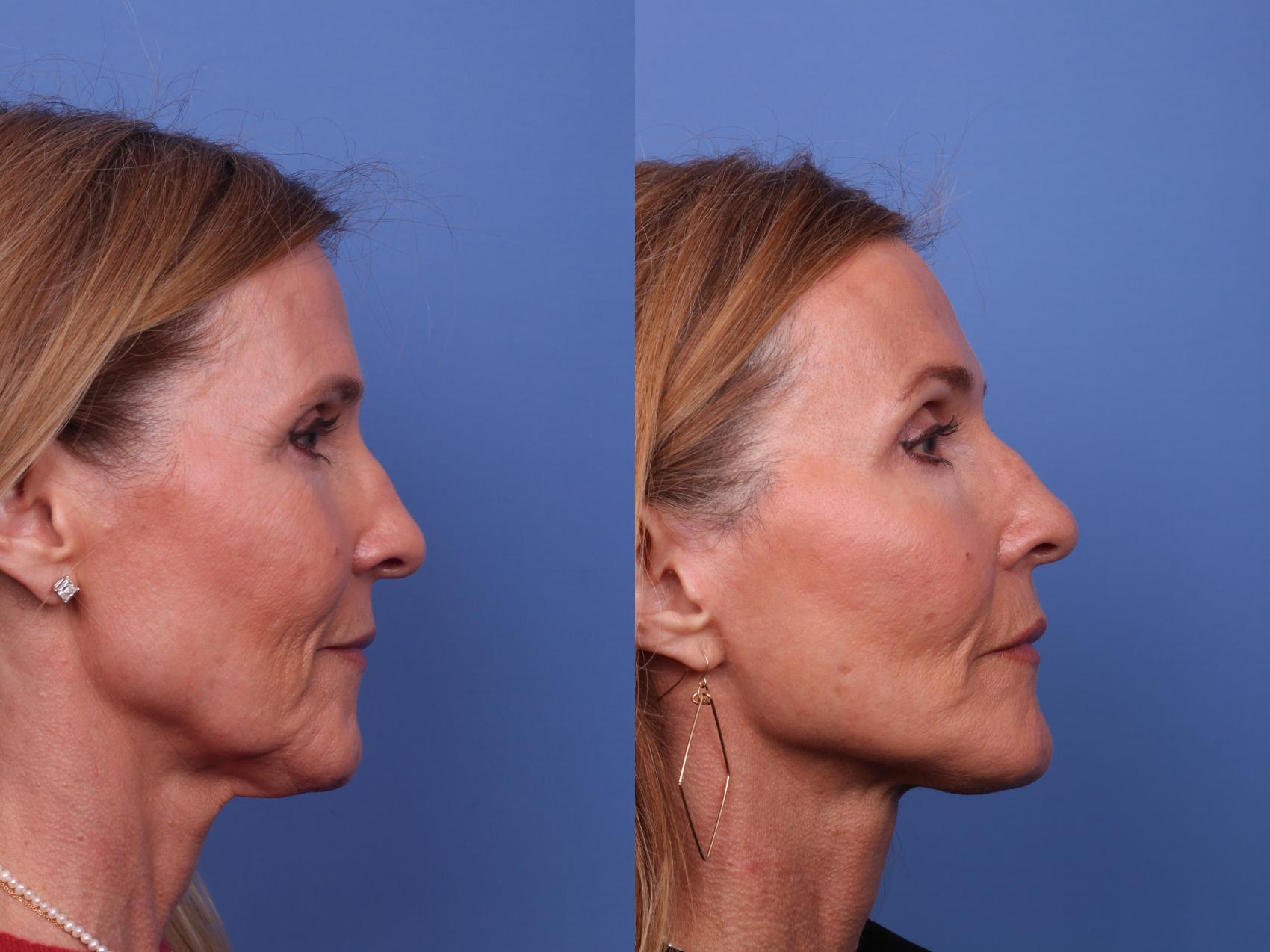 Before & After Facelift Case 515 Right Side View in Scottsdale, AZ