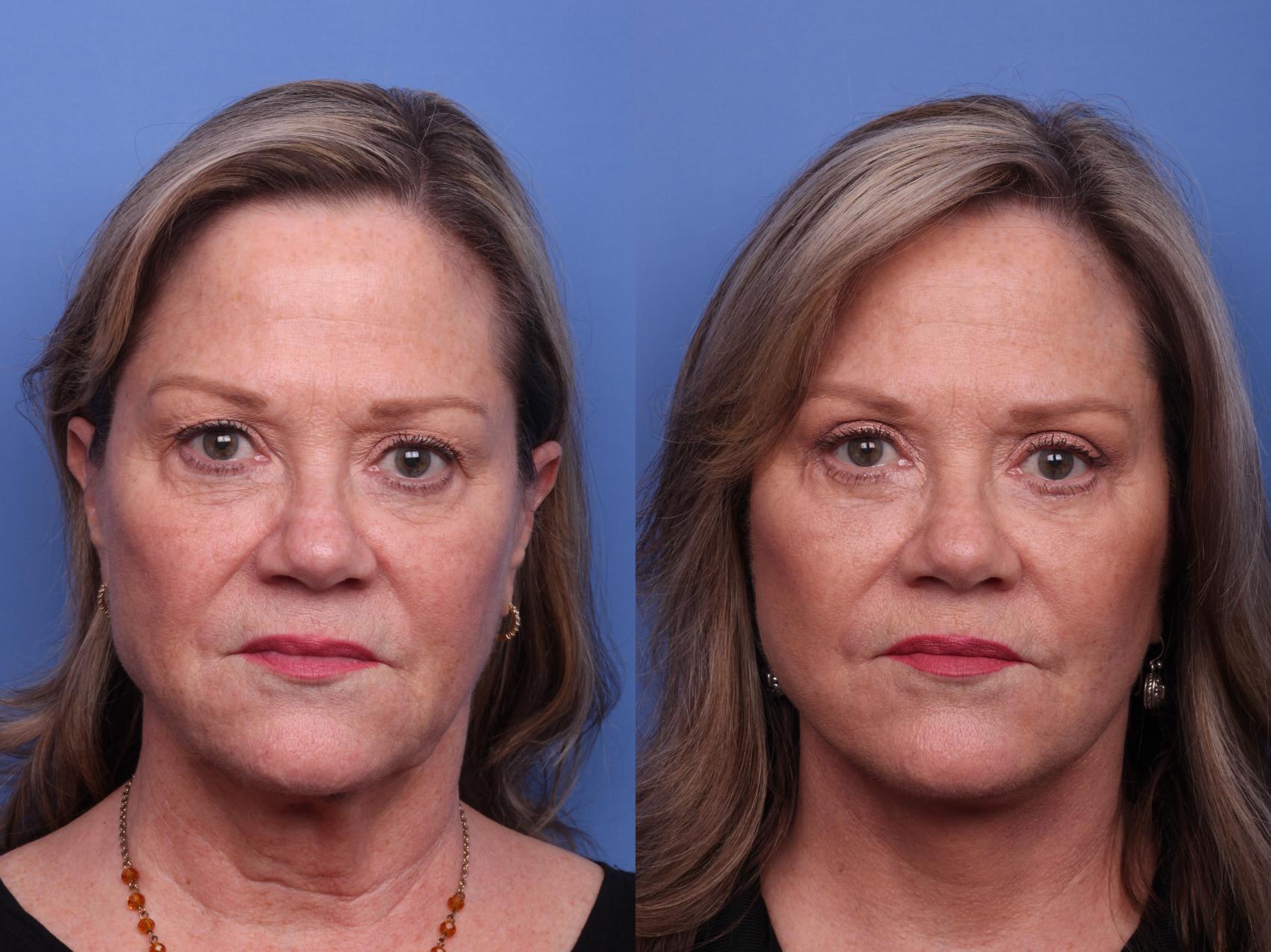 Before & After Facelift Case 517 Front View in Scottsdale, AZ