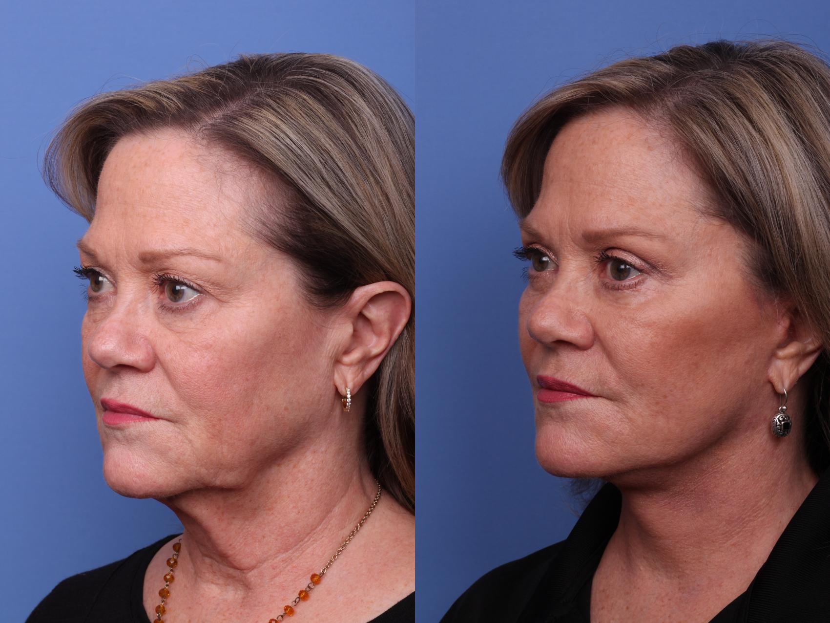 Before & After Facelift Case 517 Left Oblique View in Scottsdale, AZ