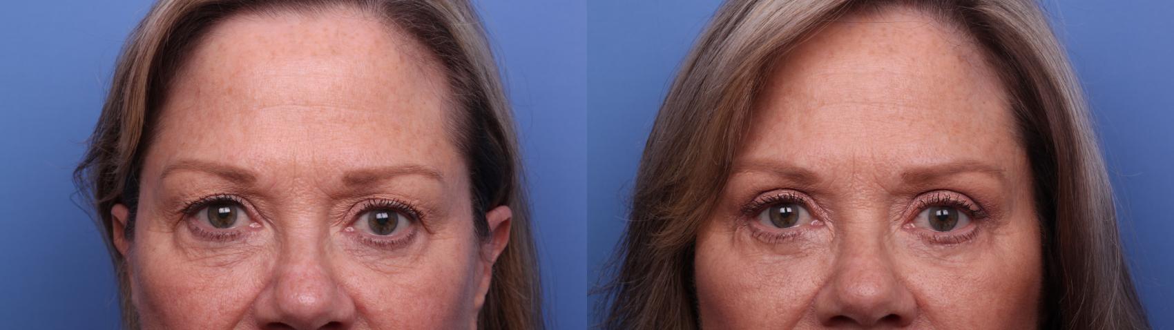 Before & After Facelift Case 517 Zoom Bleph View in Scottsdale, AZ