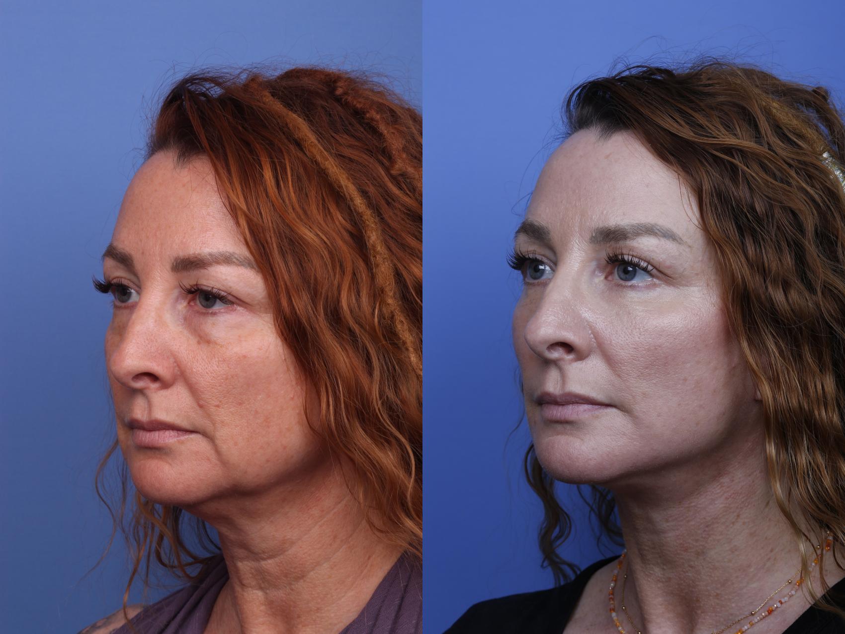 Before & After Facelift Case 520 Left Oblique View in Scottsdale, AZ