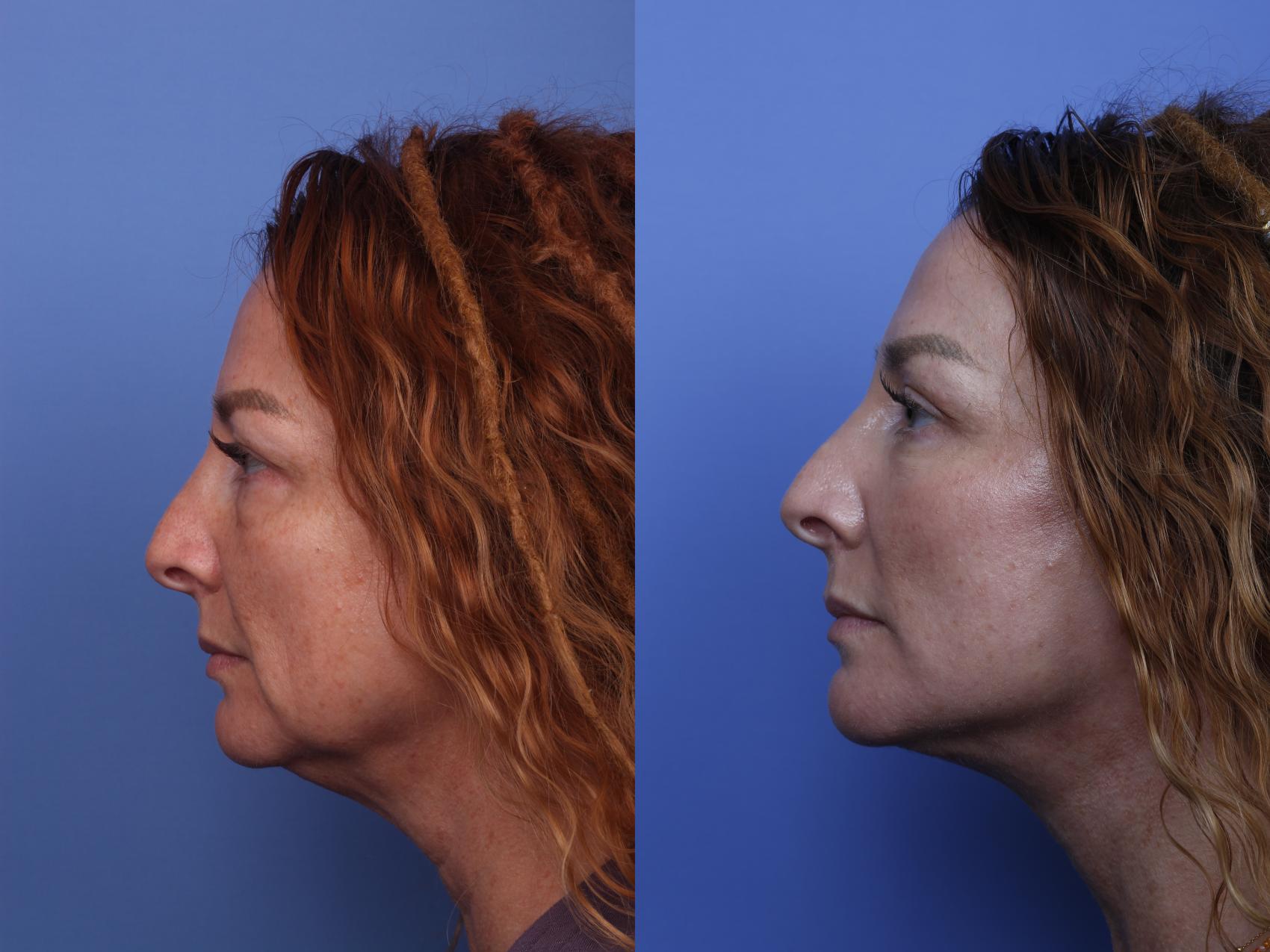 Before & After Facelift Case 520 Left Side View in Scottsdale, AZ