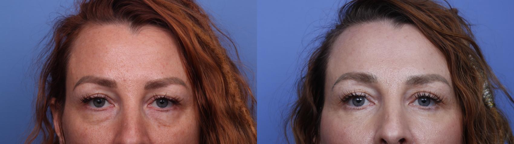 Before & After Facelift Case 520 Zoom Bleph View in Scottsdale, AZ